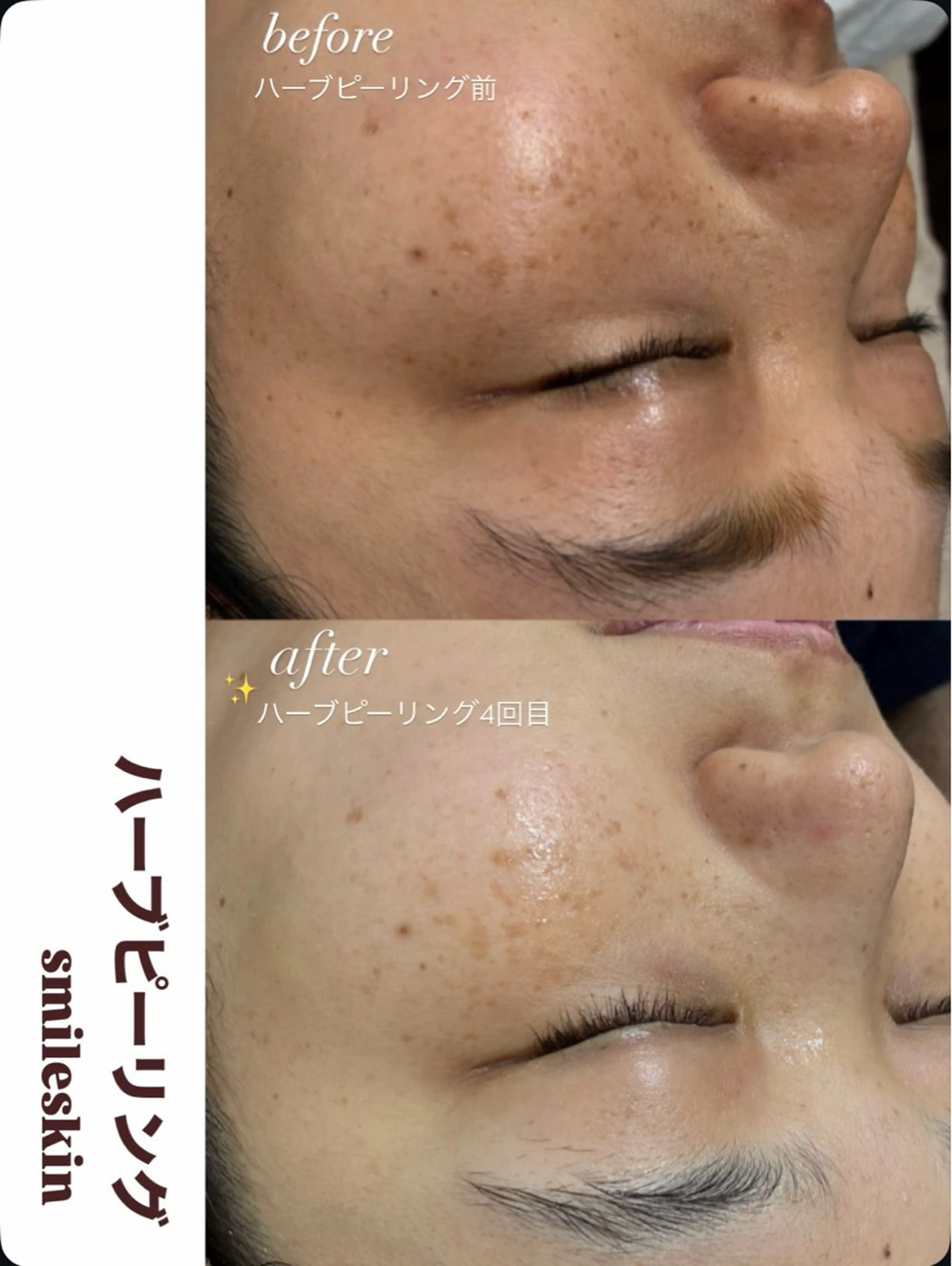 その他 smileskin 京都/meguのその他イメージ