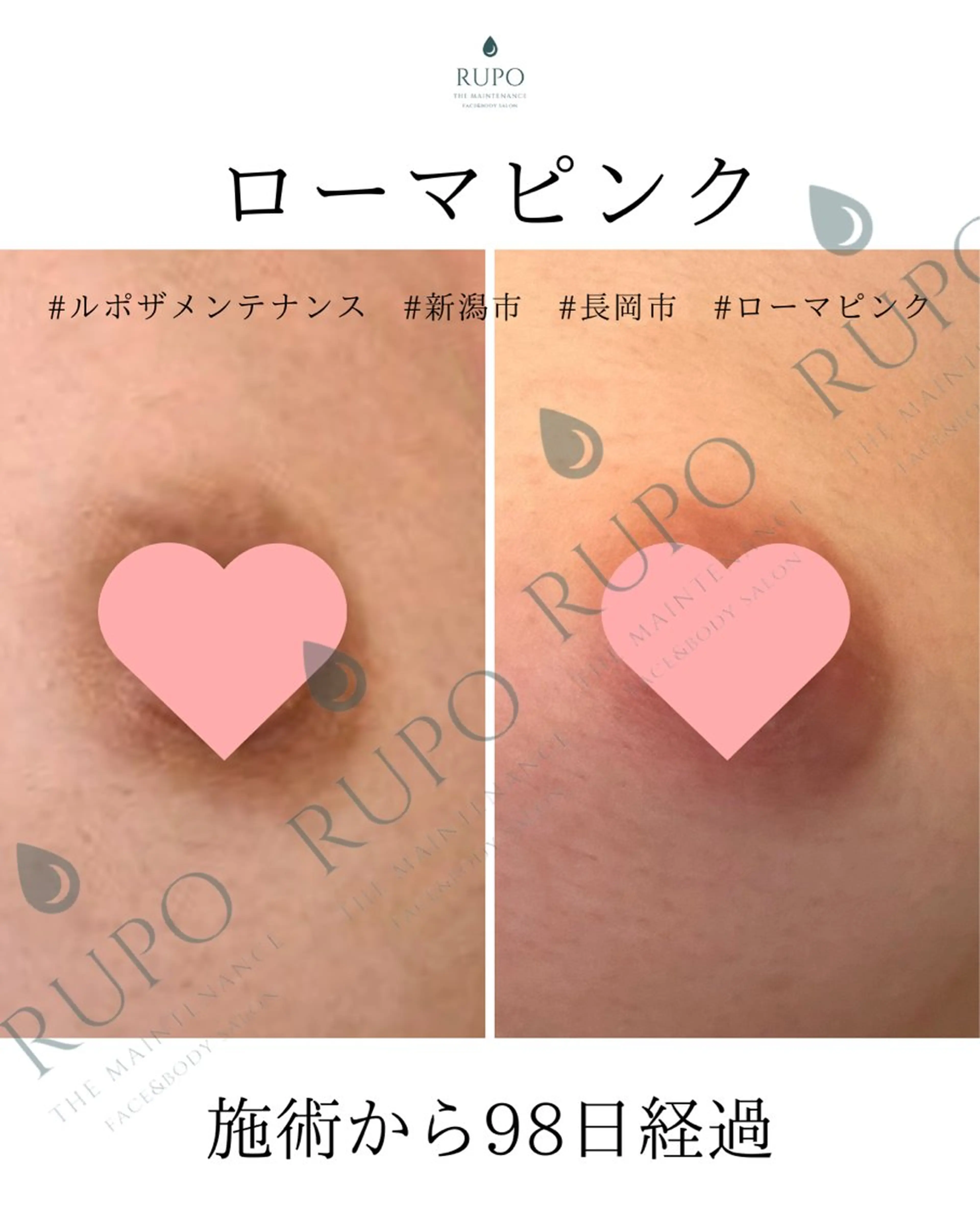 【ブラトップローマピンク】カウンセリング無料&当日施術可 通常259600/モニター158400の写真