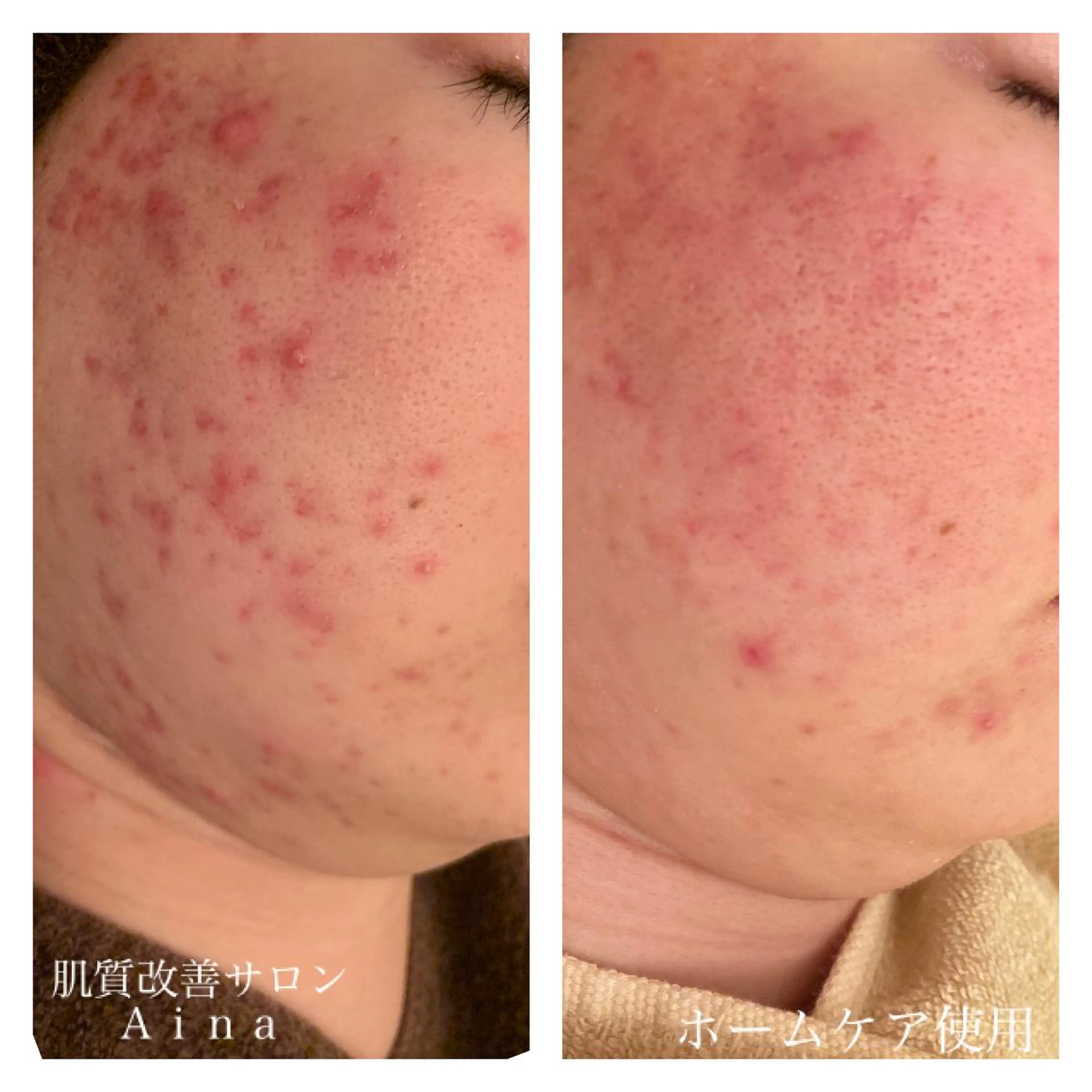 ミディアム カラー パーマ ヘアアレンジ メンズ キッズ ネイル マツエク・マツパ エステ リラク ニキビ跡専門サロン Ａｉｎａのエステ・リラクイメージ