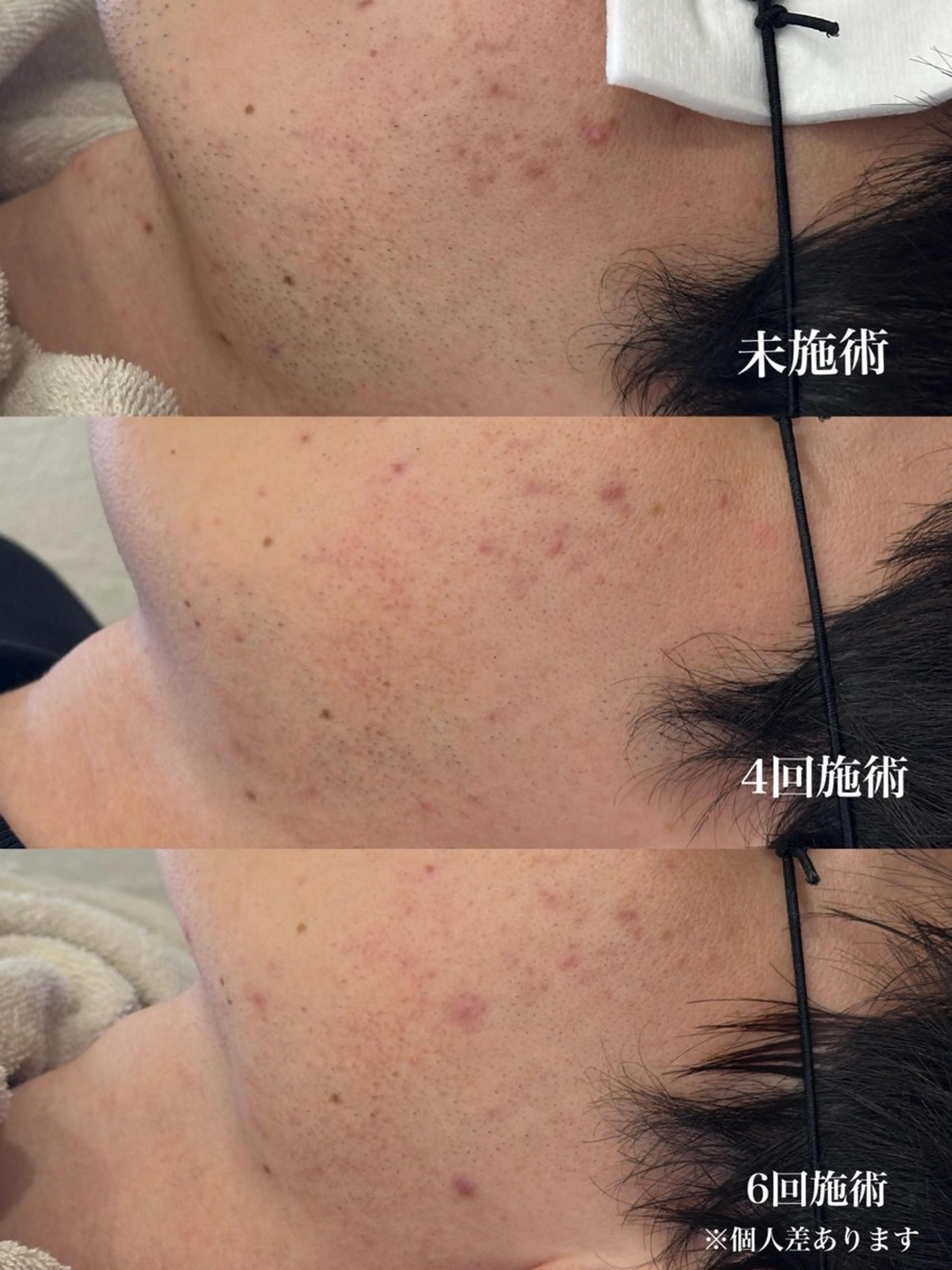 メンズ 脱毛 muumo まりののエステ・リラクイメージ