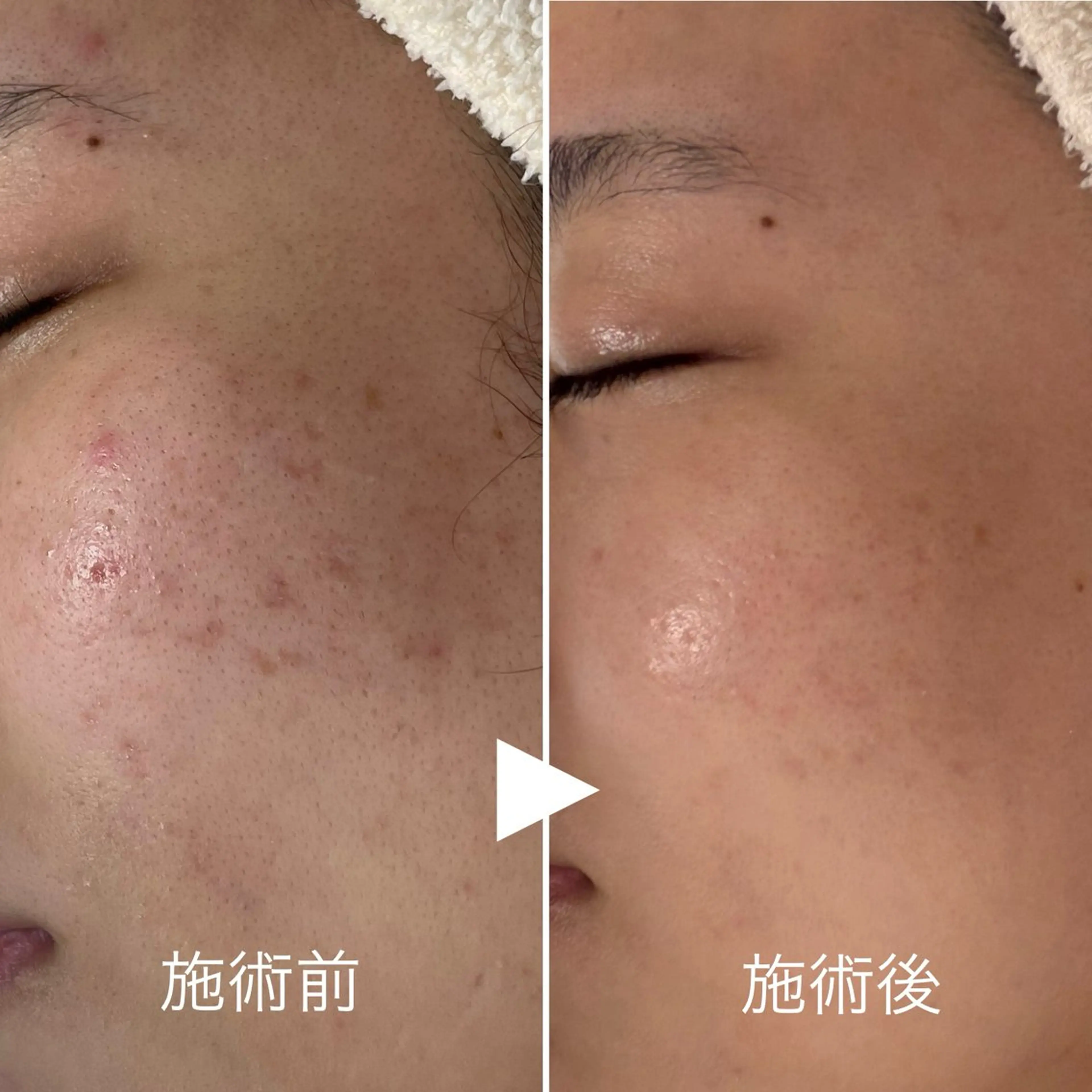 エステ ニキビ・毛穴・ フェイシャル専門店のエステ・リラクイメージ