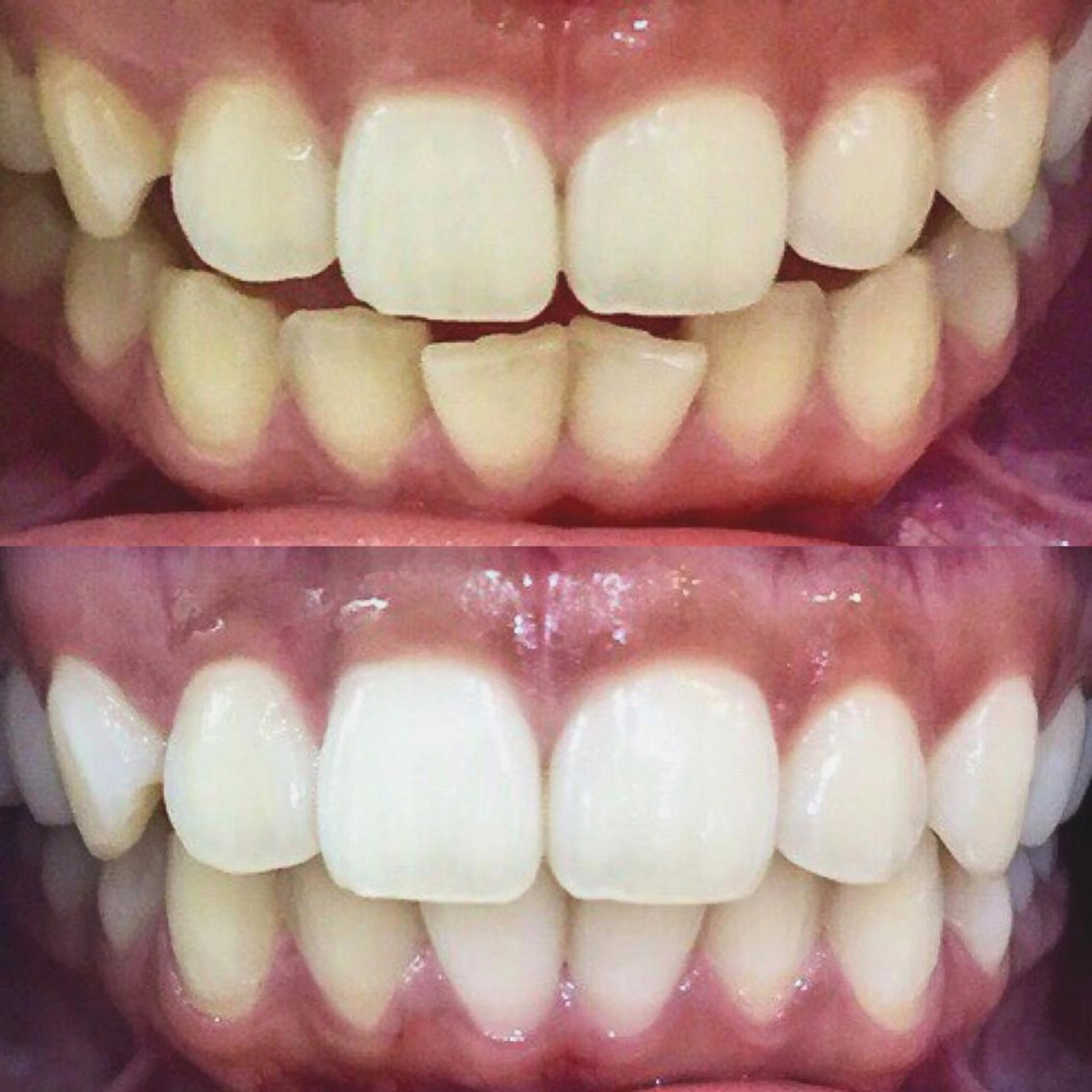 【本気で白い歯にしたい方へ】8分照射×4回🦷ノーマルセルフホワイトニングの写真