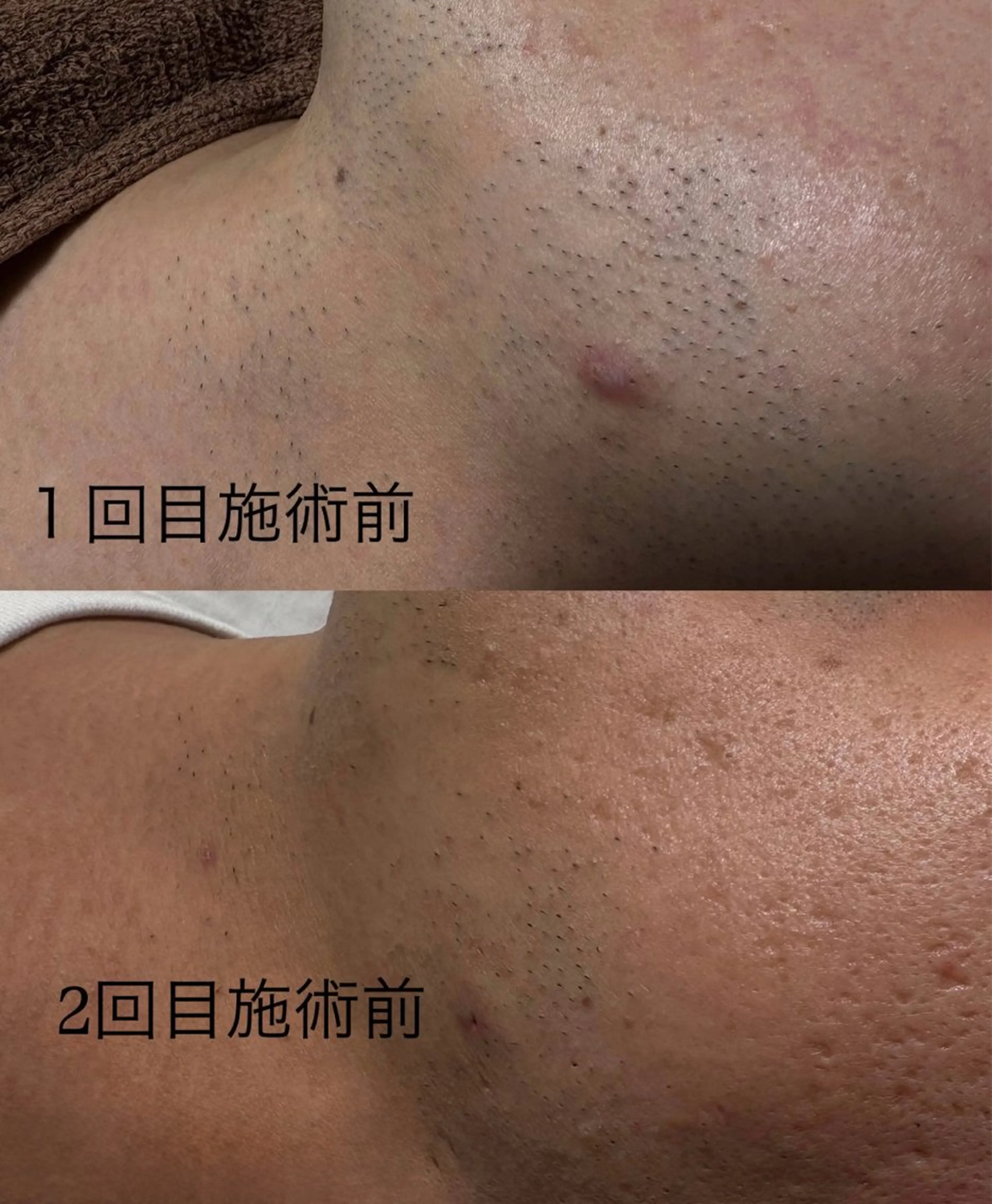 脱毛 よもぎ蒸し＆脱毛 リラクReethiのエステ・リラクイメージ