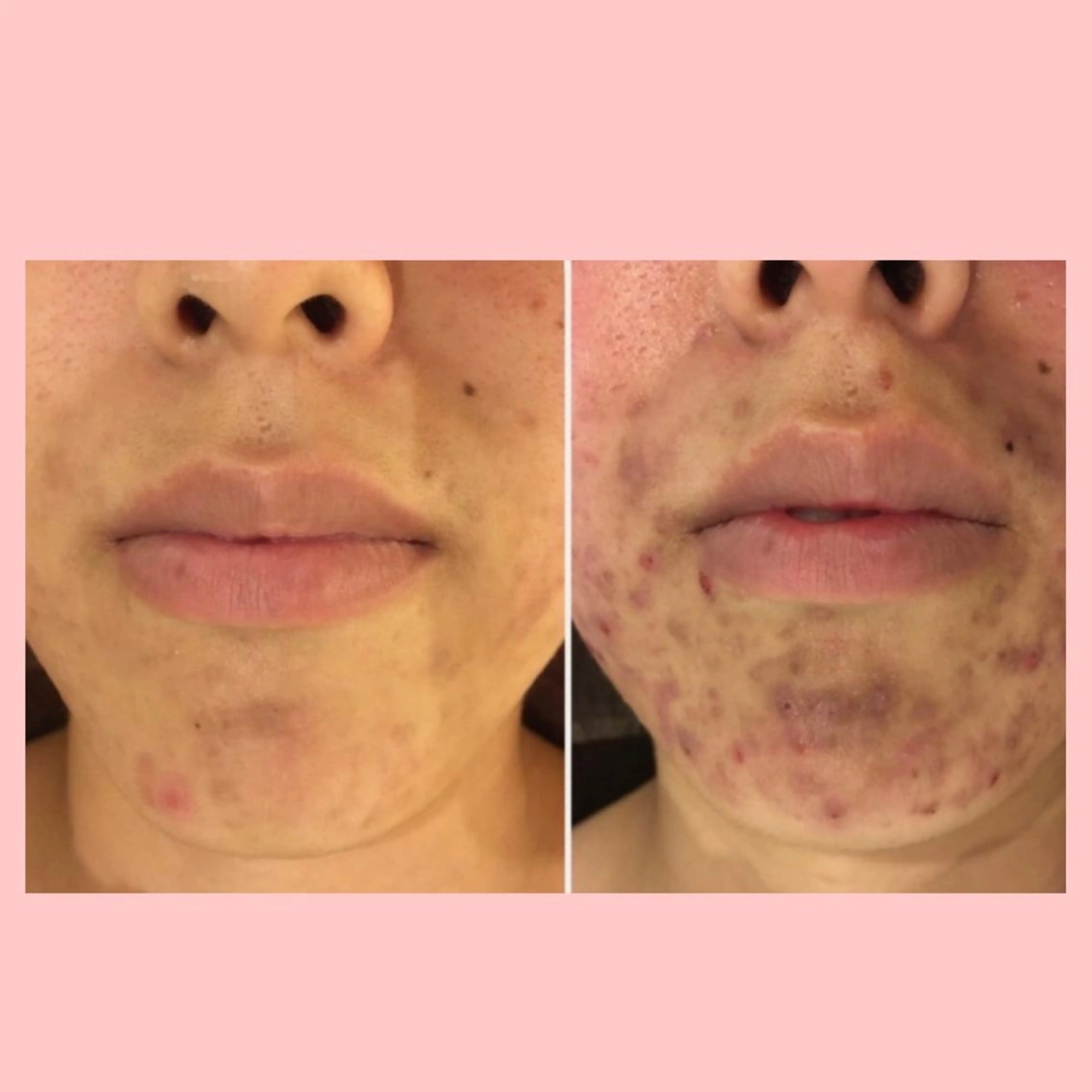 セミロング カラー パーマ ヘアアレンジ メンズ キッズ ネイル マツエク・マツパ エステ リラク 3か月で肌革命👼 ニキビ専門店💫のエステ・リラクイメージ