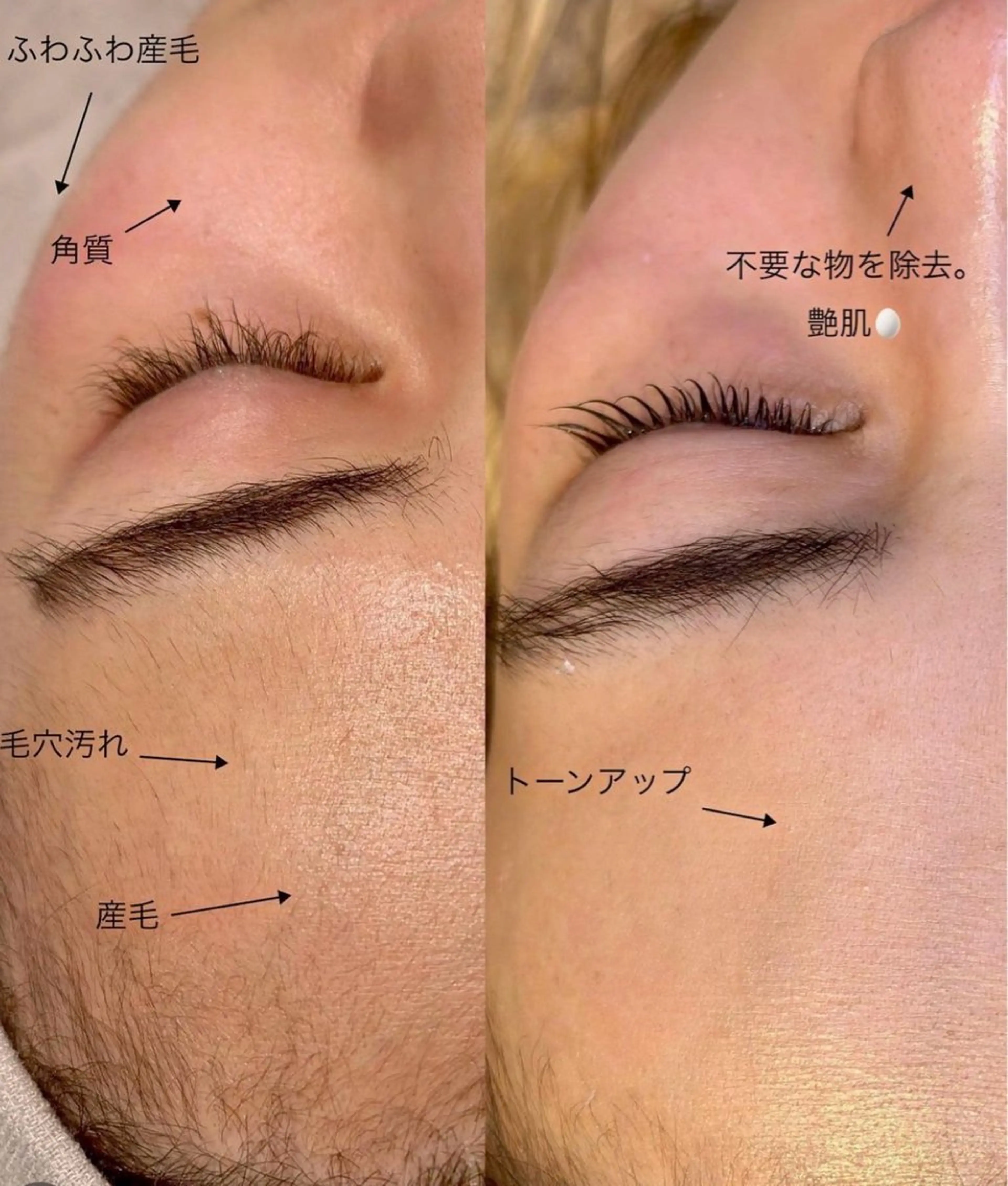 4月19日日曜日限定✨【艶肌完成】フェイスWAX脱毛＋美肌エステの写真