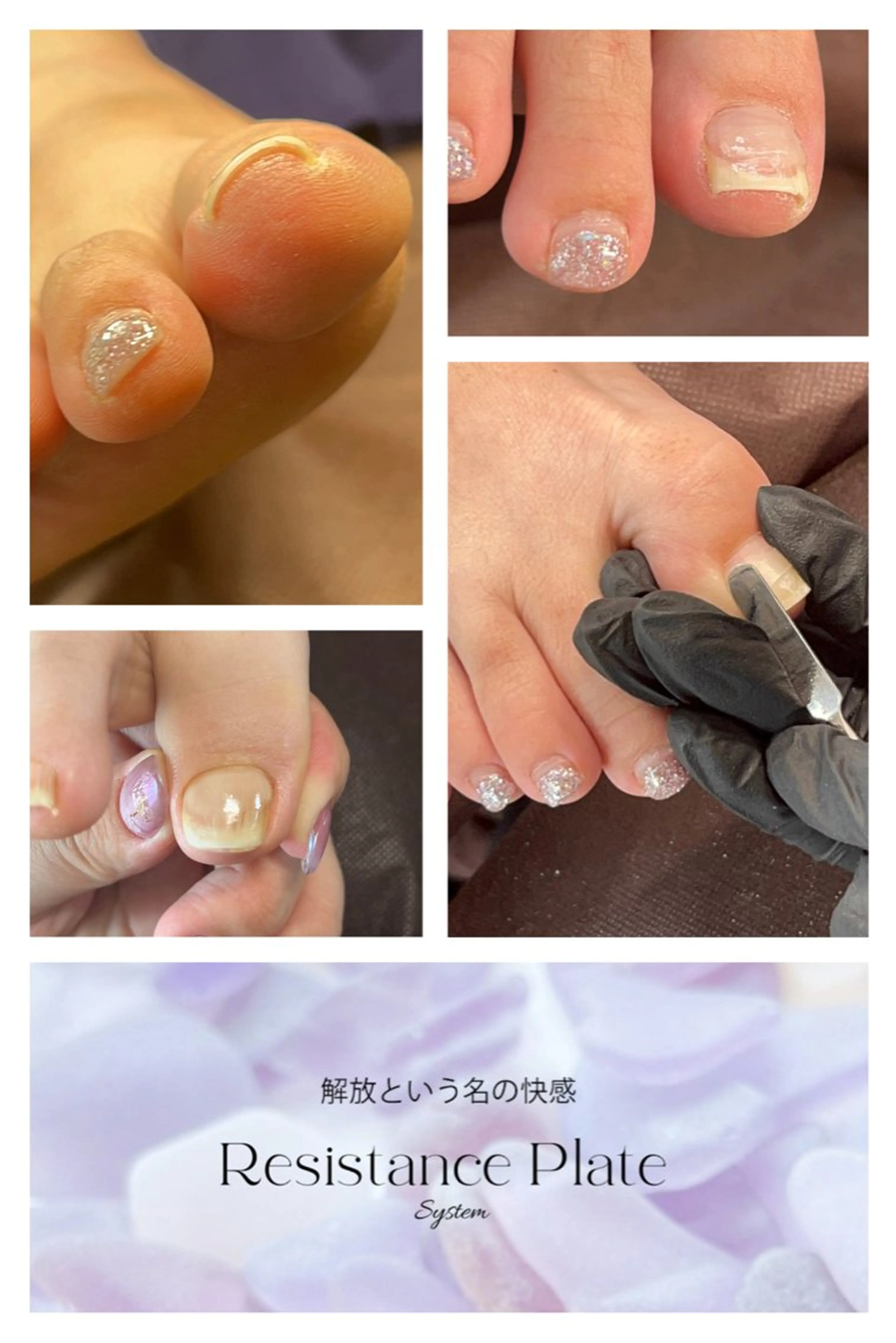 痛くない巻き爪解放🦶🏻✨両親指２本分✨フットバス付き🛁の写真