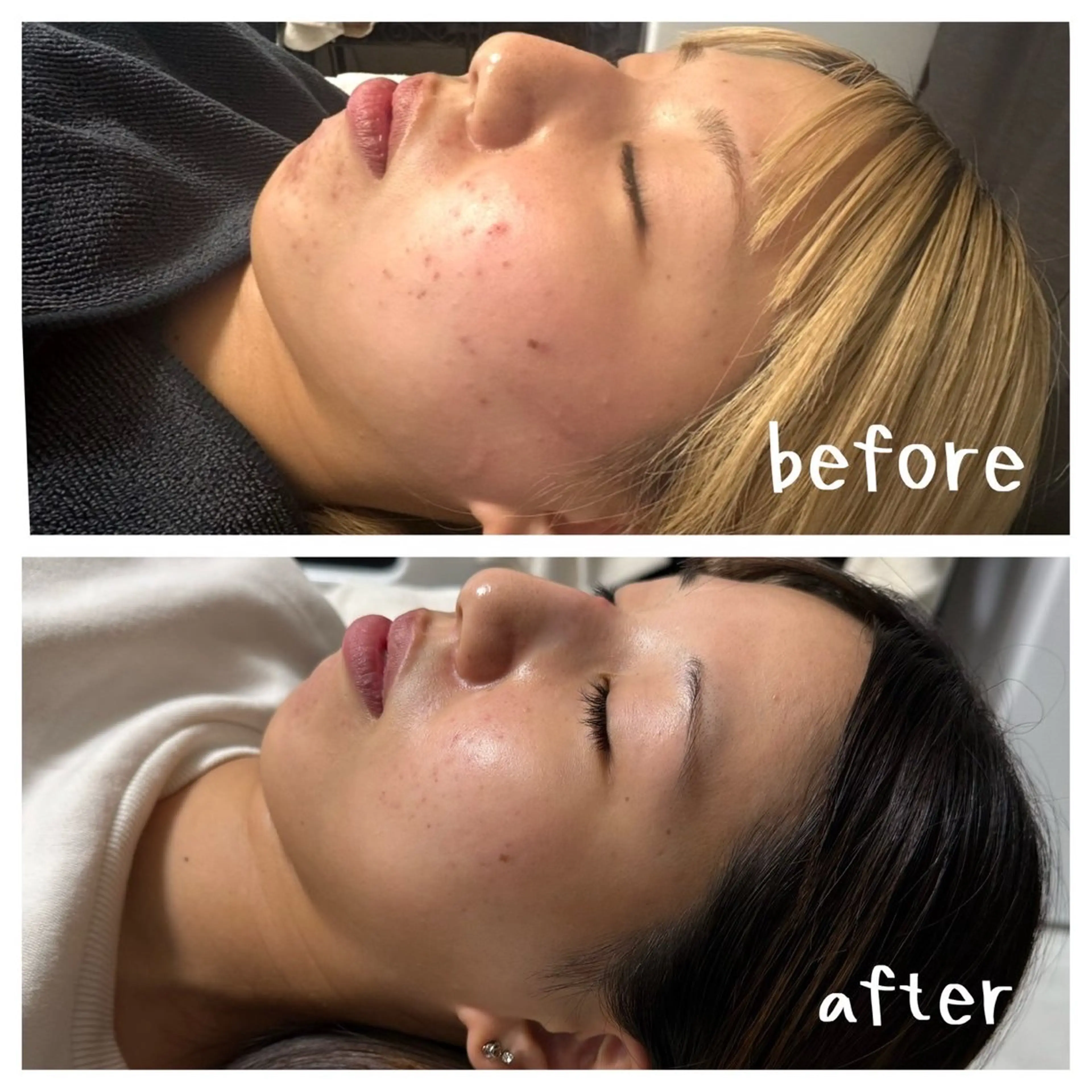 医療提携Ruby小顔 ハーブピーリング加藤のエステ・リラクイメージ