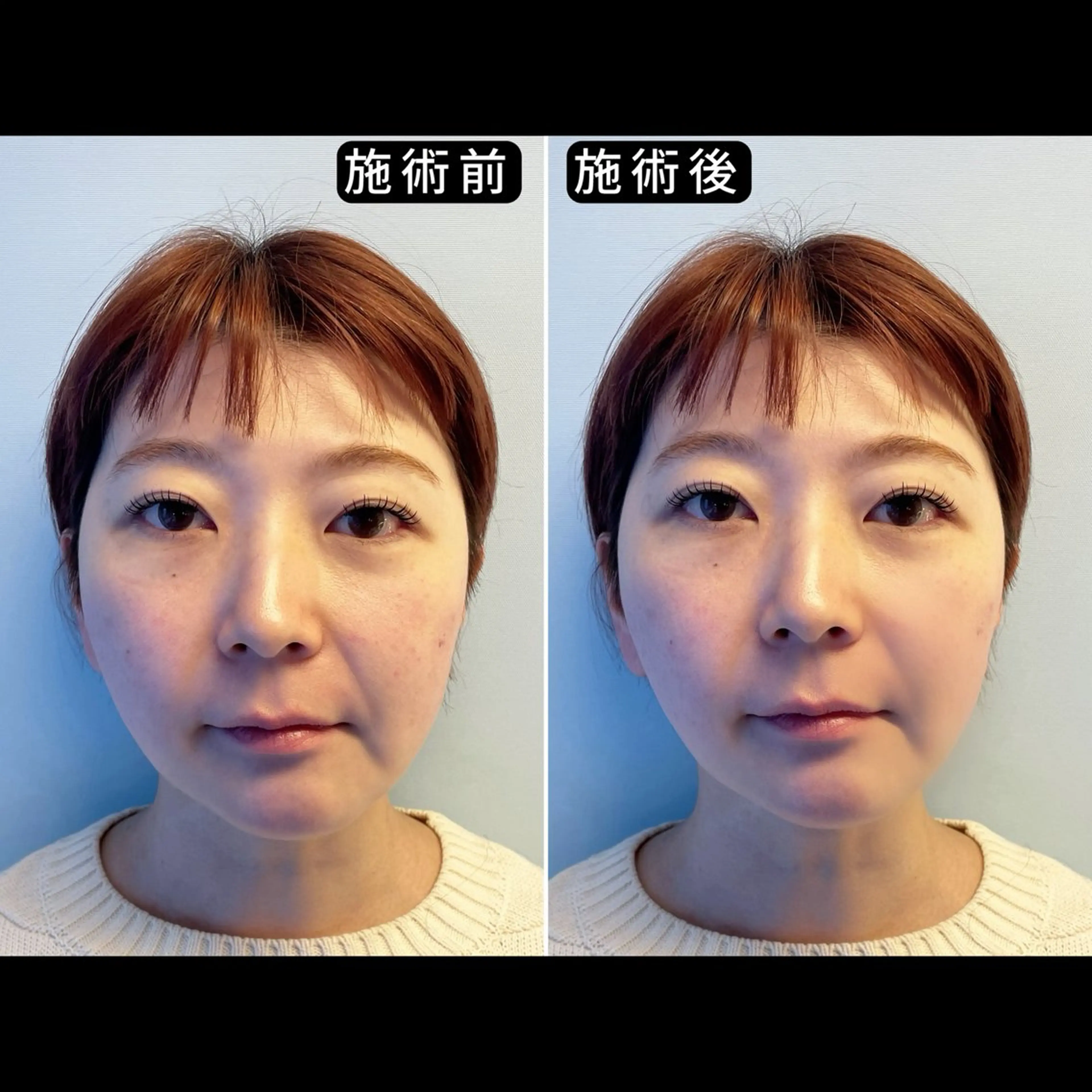 【ほうれい線・左右差を整えるスペシャルケア】美容整体×EMS3種×美容鍼の写真