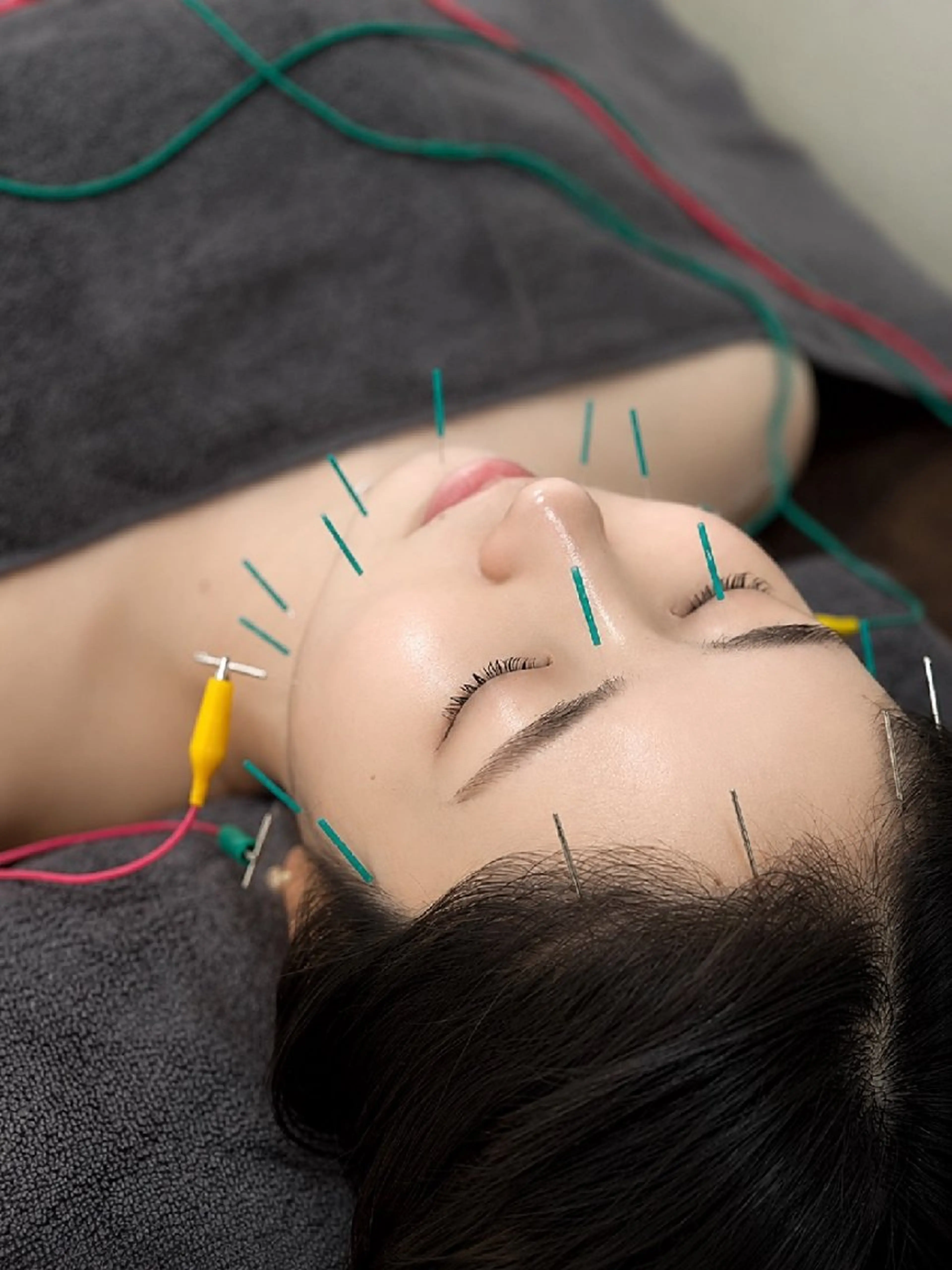 【強刺激で★圧倒的小顔効果◎】美容鍼×強刺激電気パルスの写真