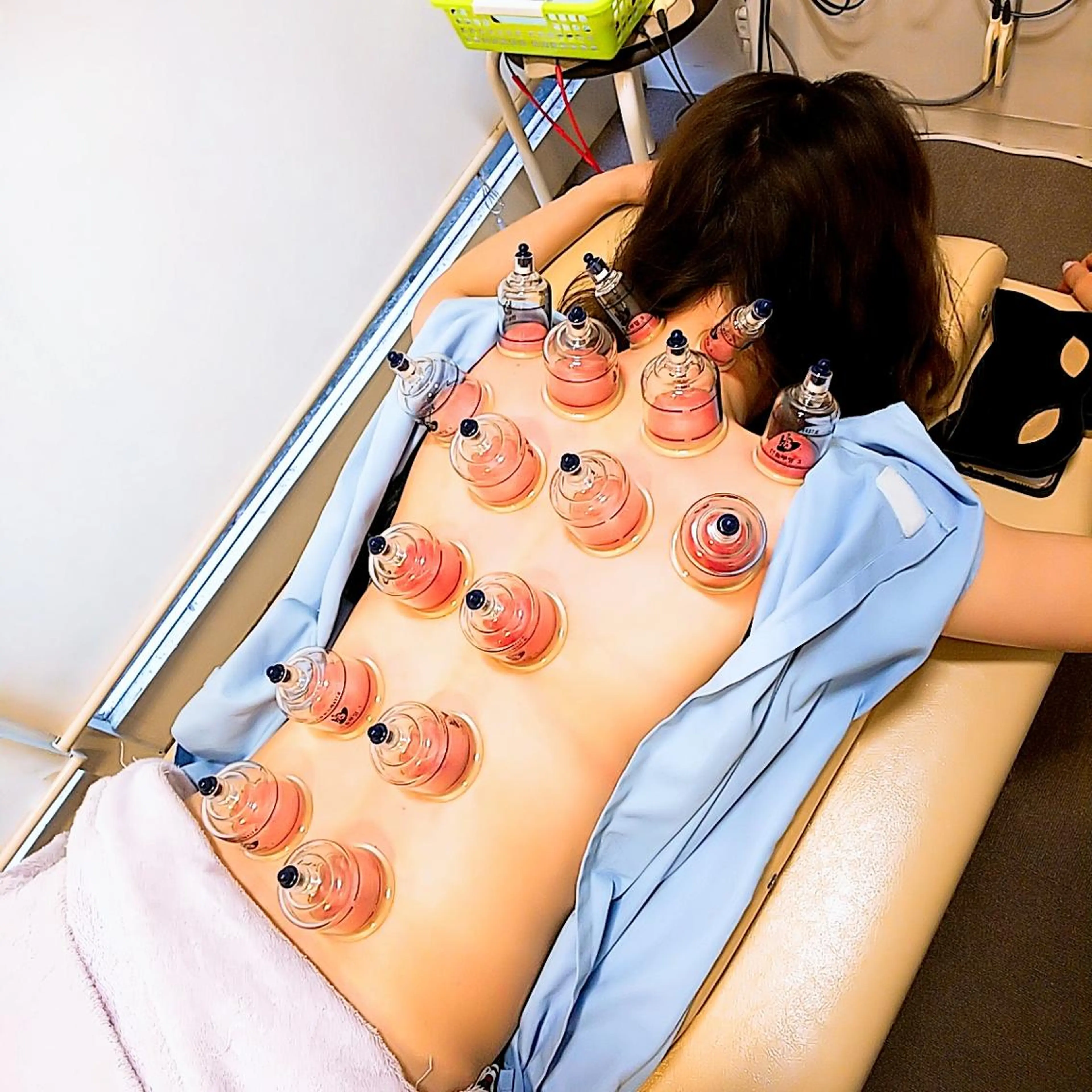 リフトアップ・たるみ ☆美容鍼小顔矯正のその他イメージ