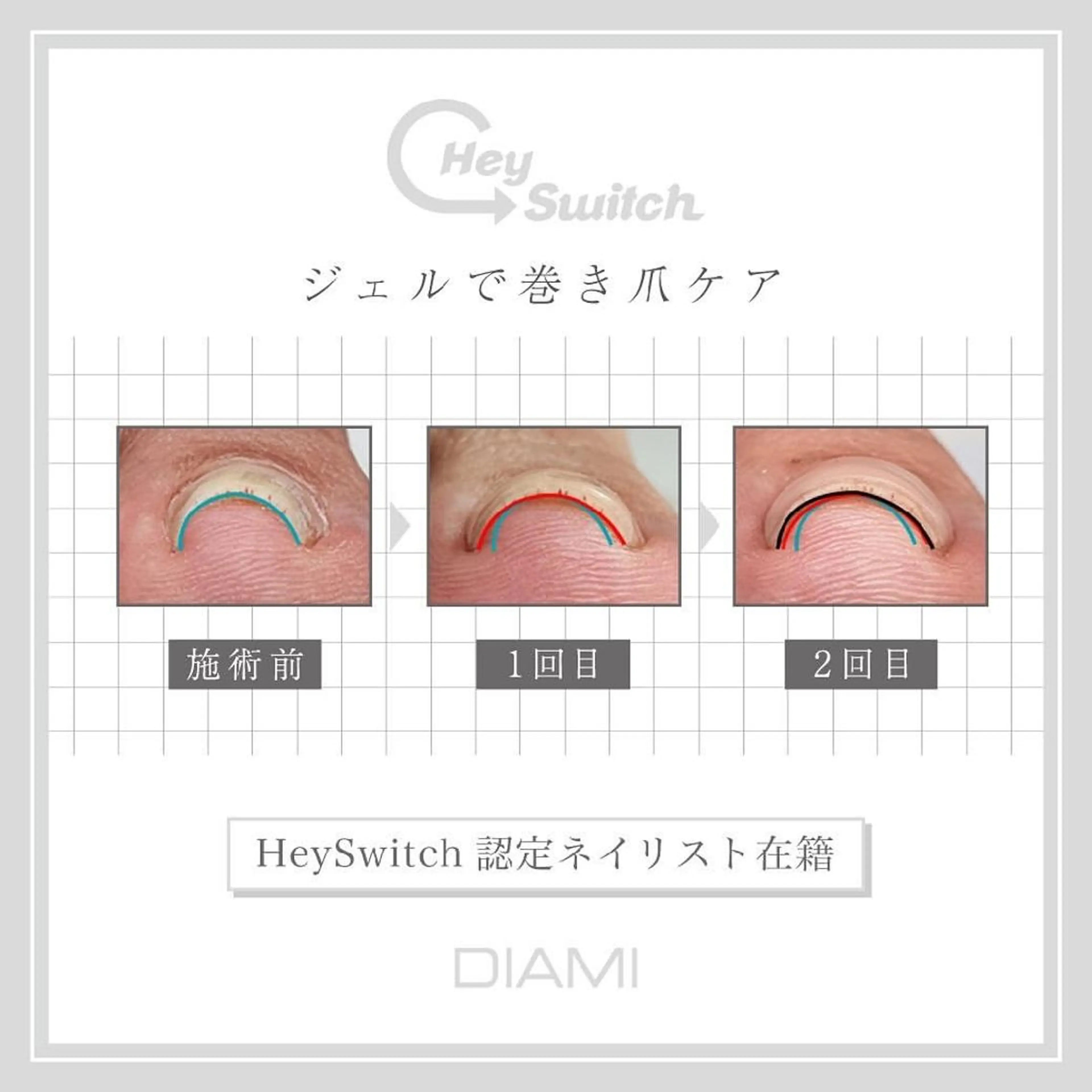 ご新規様✨Hey Switch巻き爪ケアメニュー👣の写真