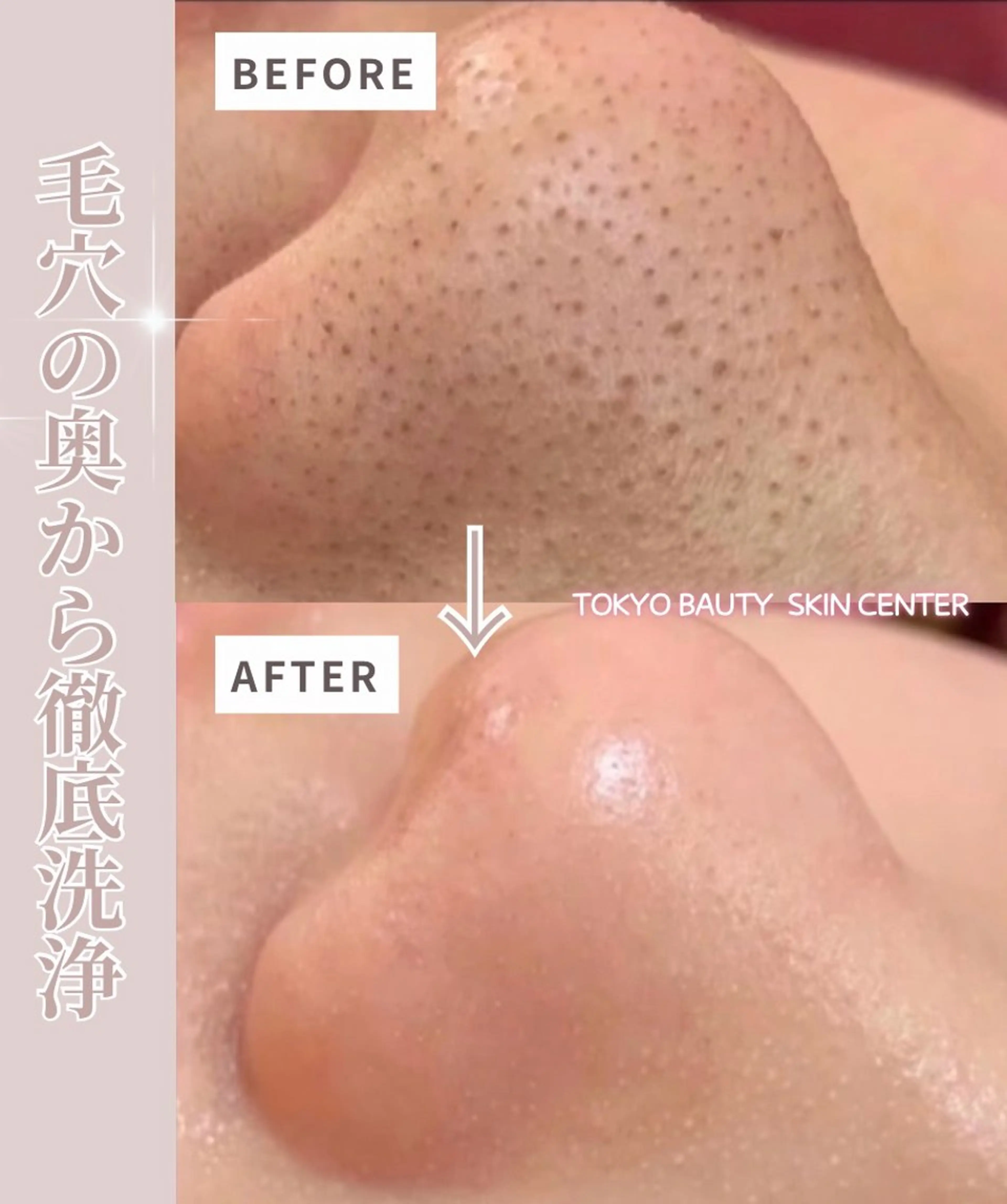 【毛穴の黒ずみ/角栓/いちご鼻/気になる方はこちら】ハイドラ毛穴洗浄フェイシャル&PDRN美白液導入/保湿水光肌への写真