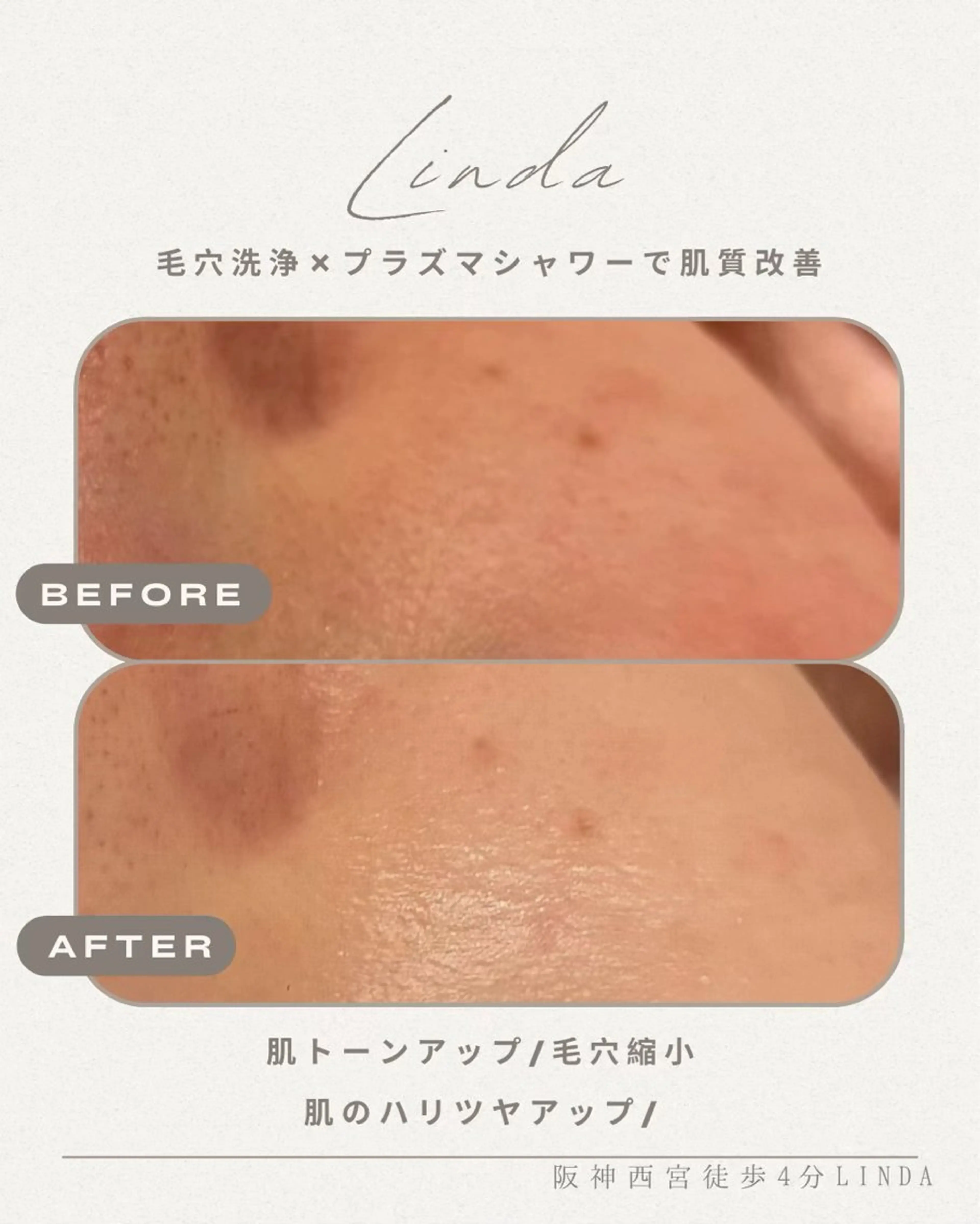 エステ 小顔&毛穴・肌質改善 LINDA西宮 AIのエステ・リラクイメージ