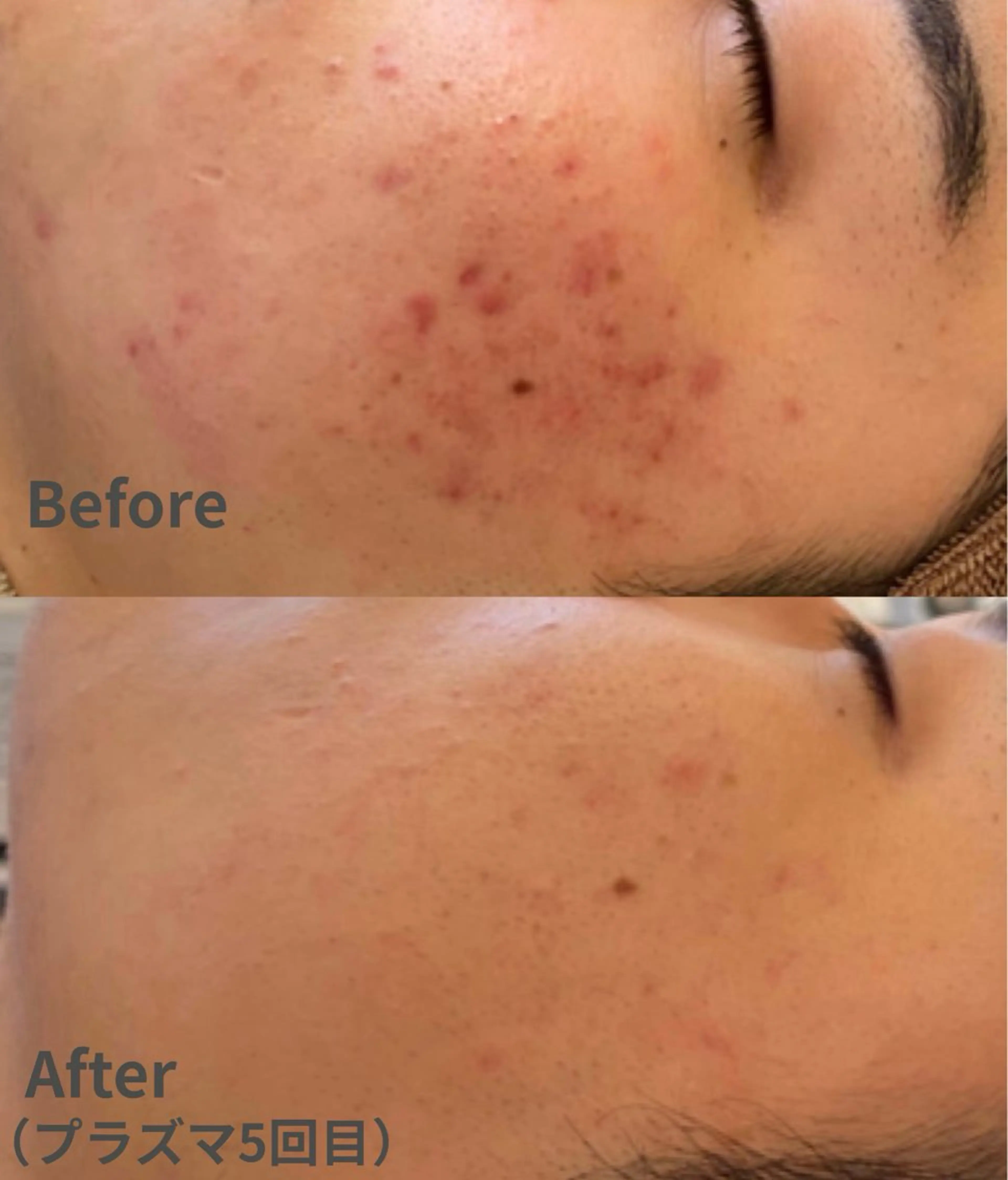 【ニキビケア】プラズマシャワー＋美容液導入¥5,000の写真