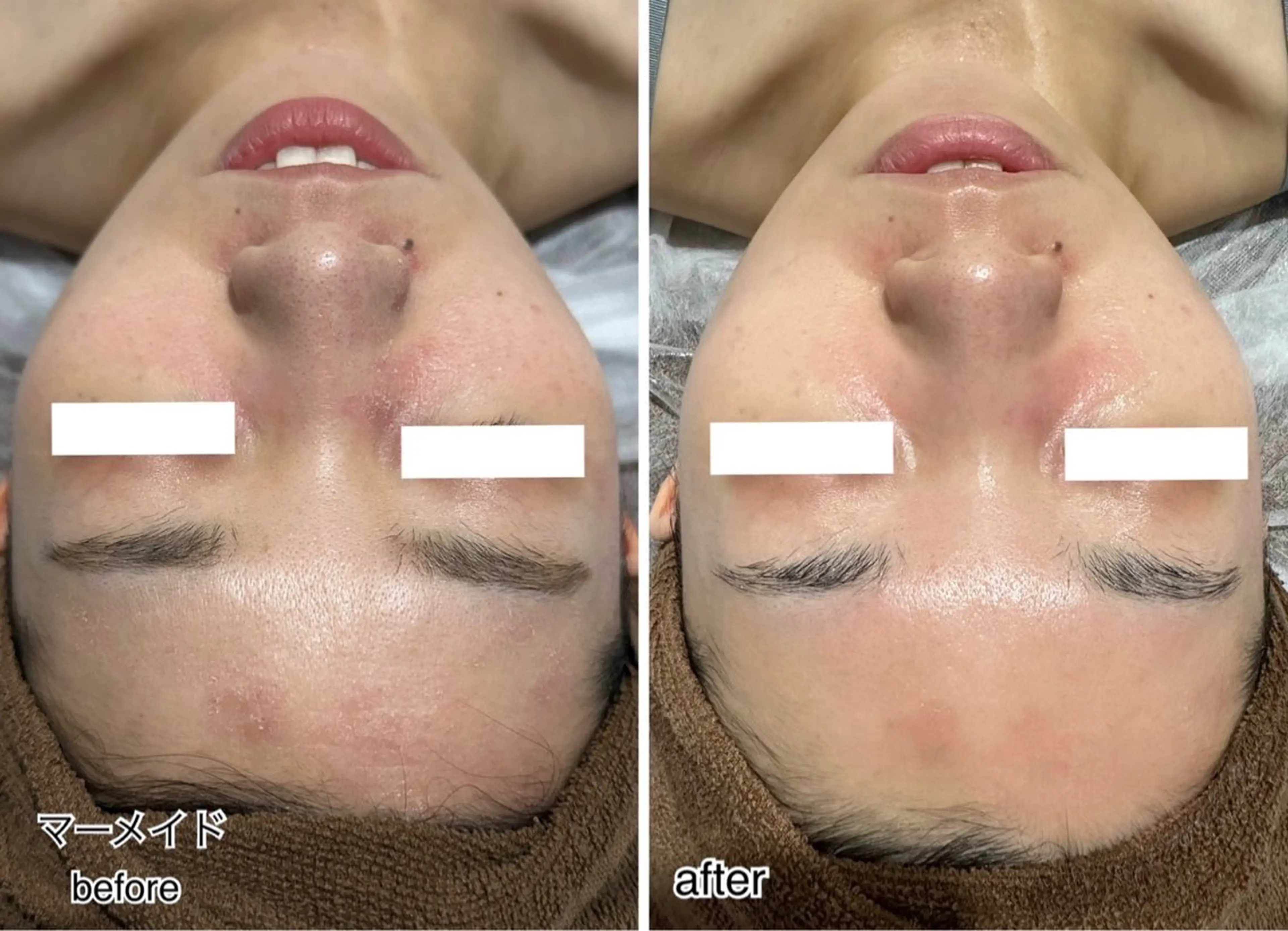 エステ ENCHANT Kaede/肌質改善のその他イメージ