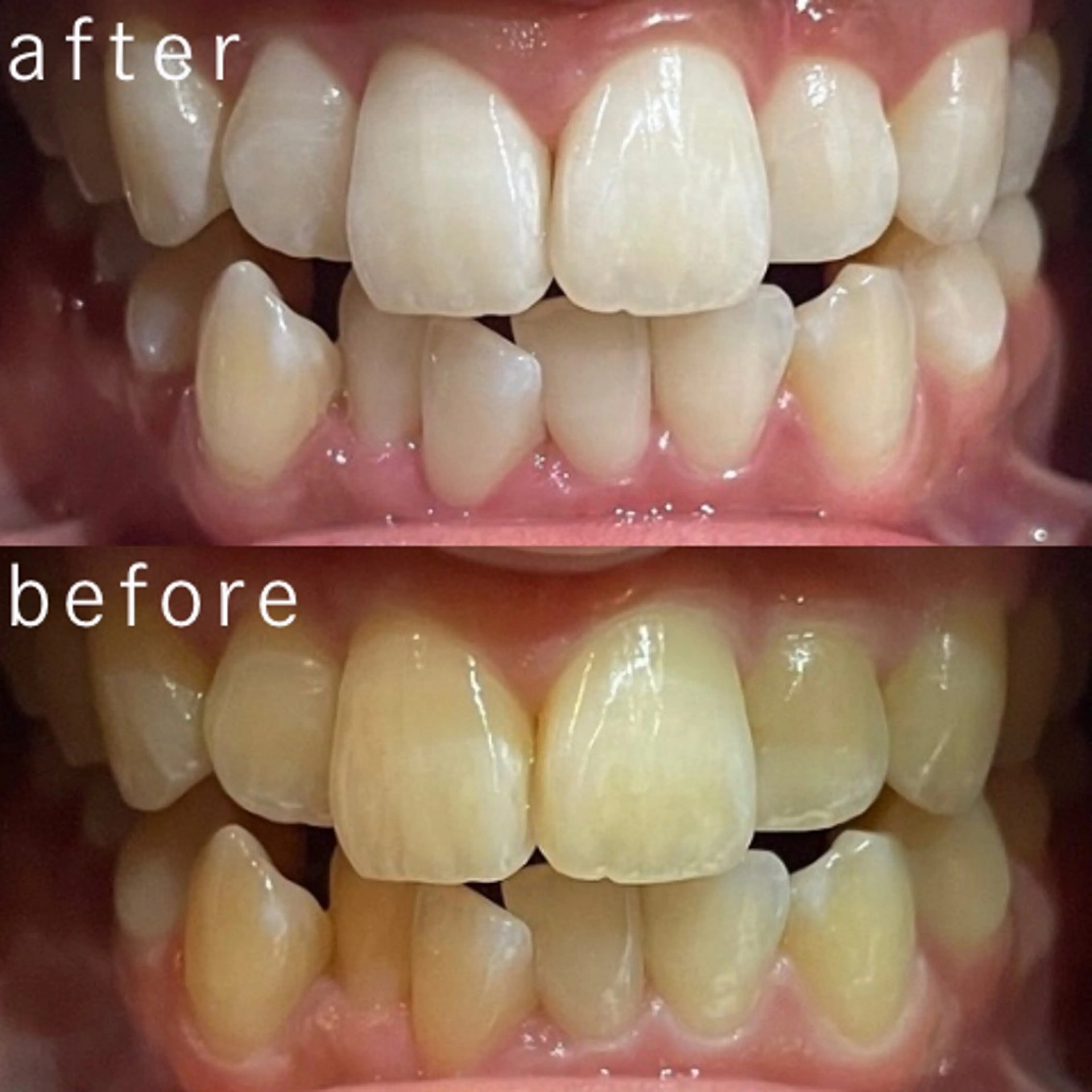 その他 サクッとホワイト都立大学店所属・セルフホワイトニング 都立大学🦷✴︎のその他イメージ