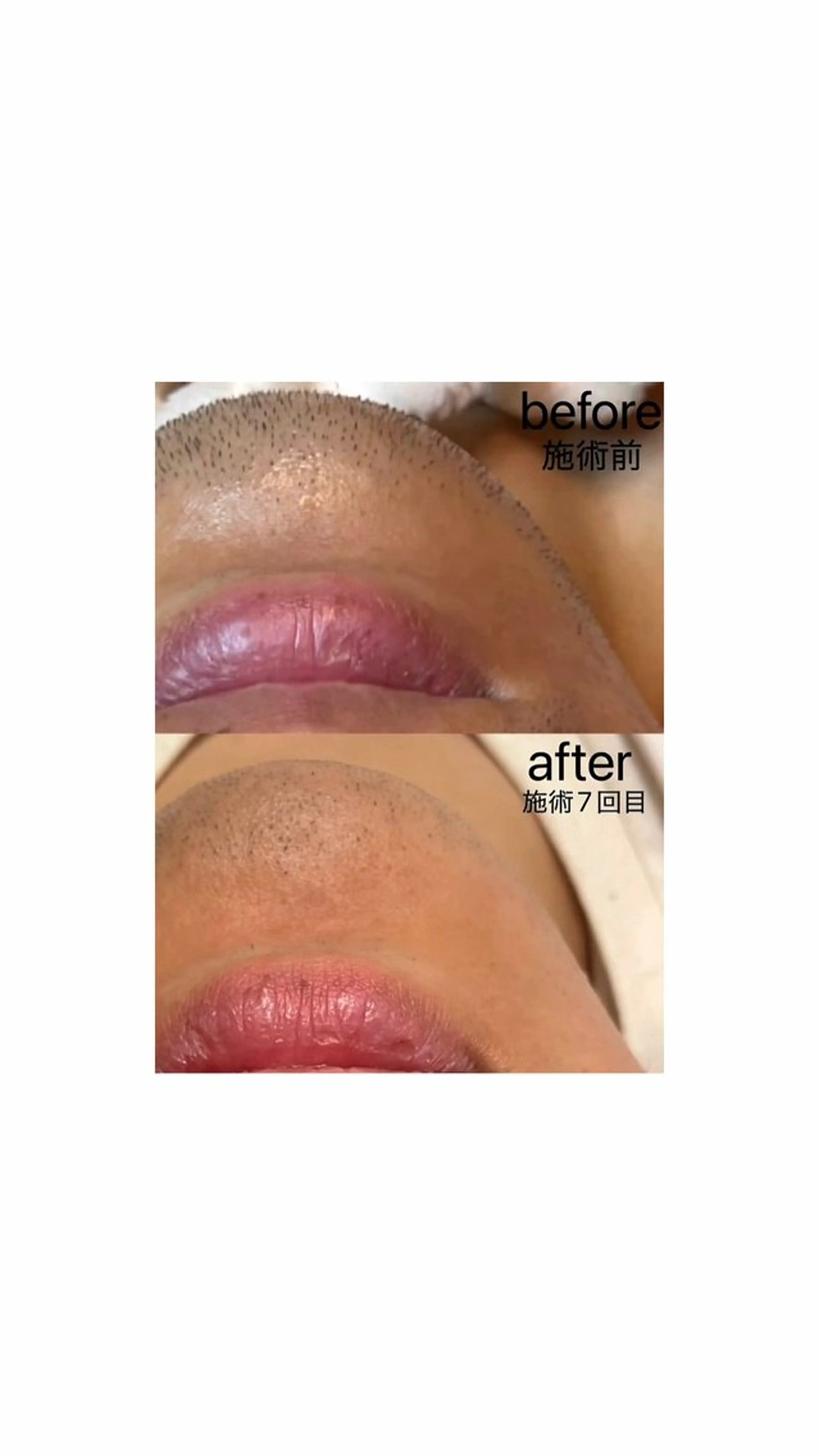 メンズ 脱毛 KA PILINAのエステ・リラクイメージ