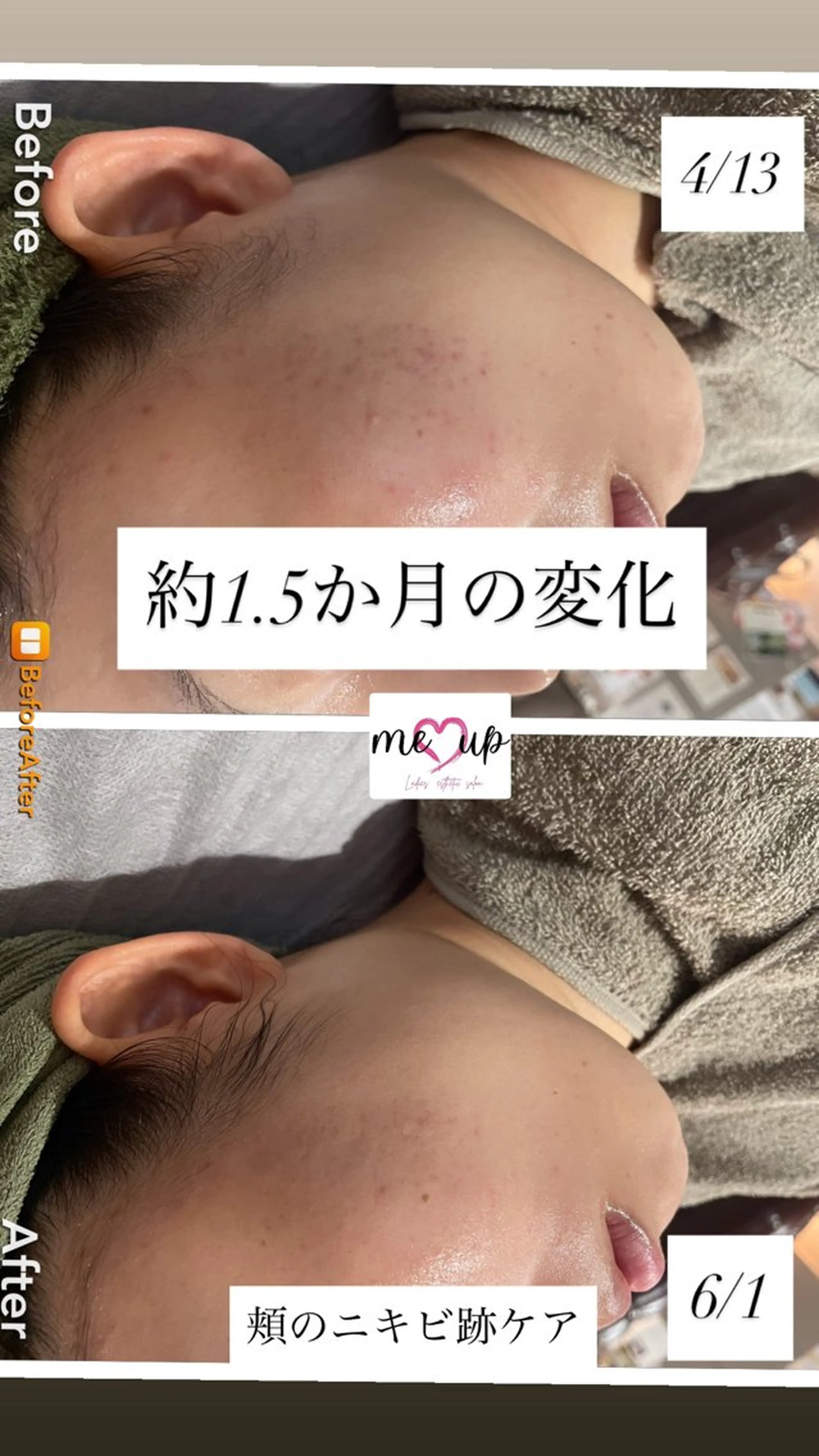 エステ Meupニキビ専門店 背中/ハーブ/肌管理のその他イメージ