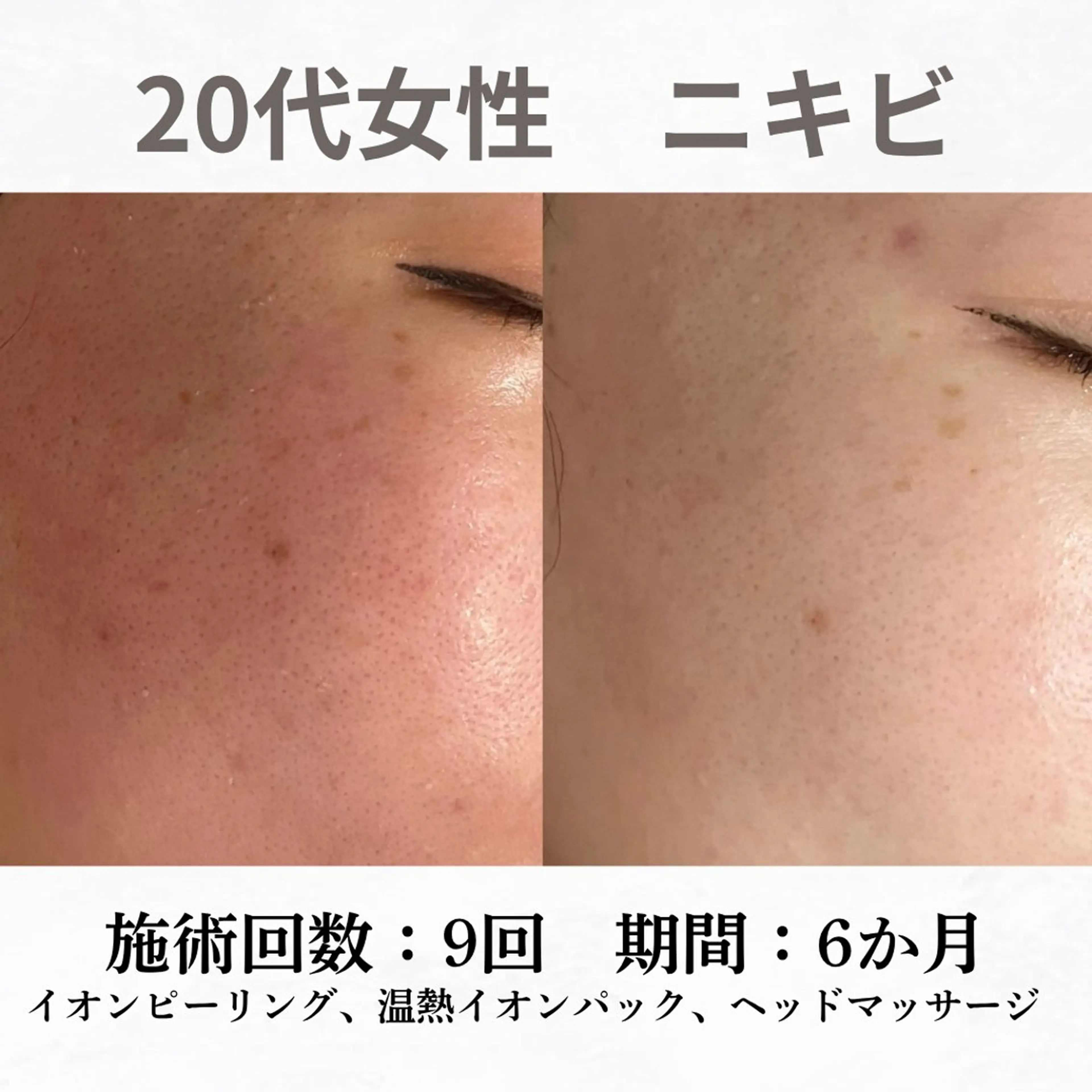 重度ニキビ専門🌷 ダウンタイムなしのエステ・リラクイメージ