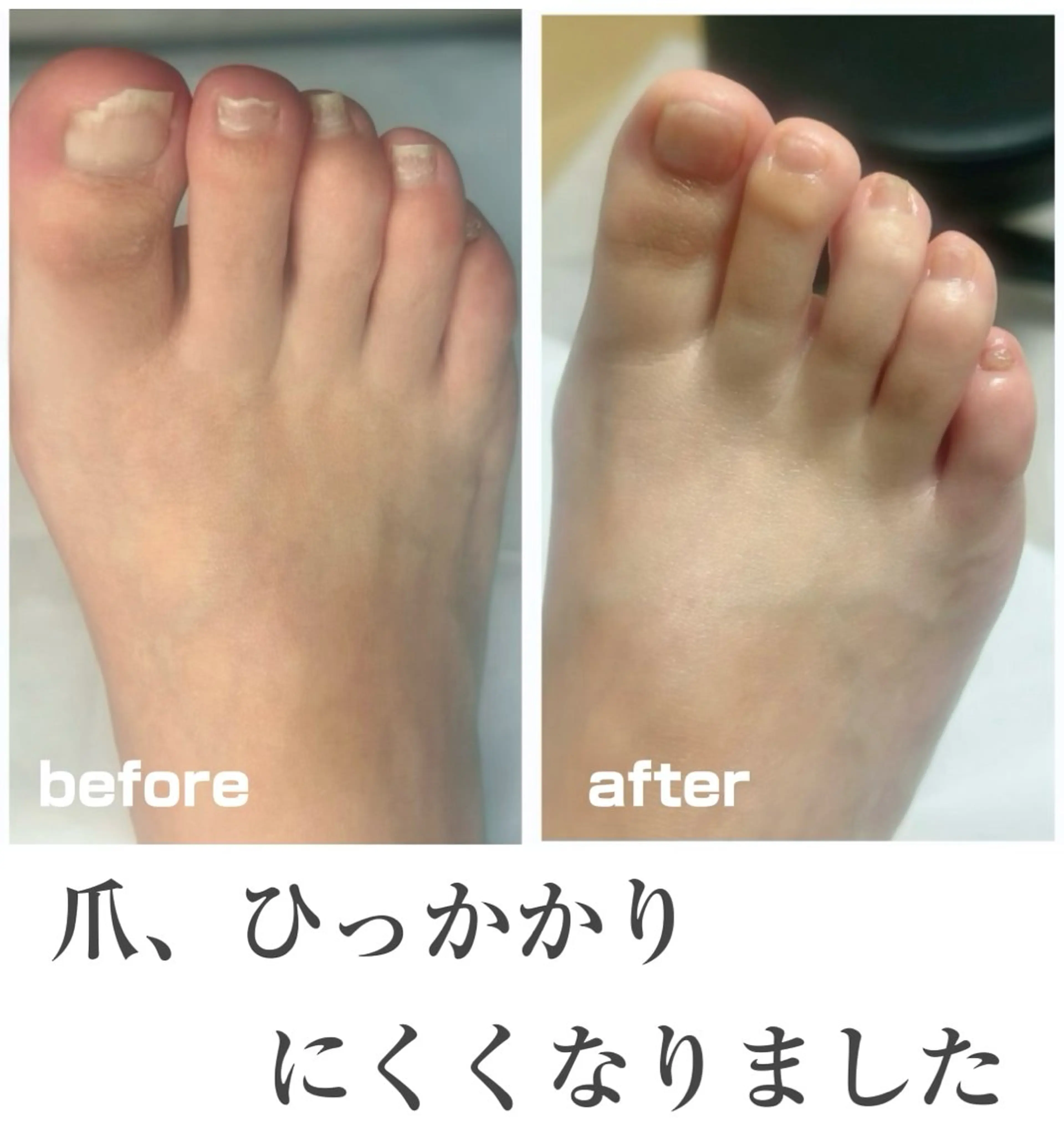 その他 巻き爪フットケアサロンKotori所属・フットケアサロン Kotoriのその他イメージ