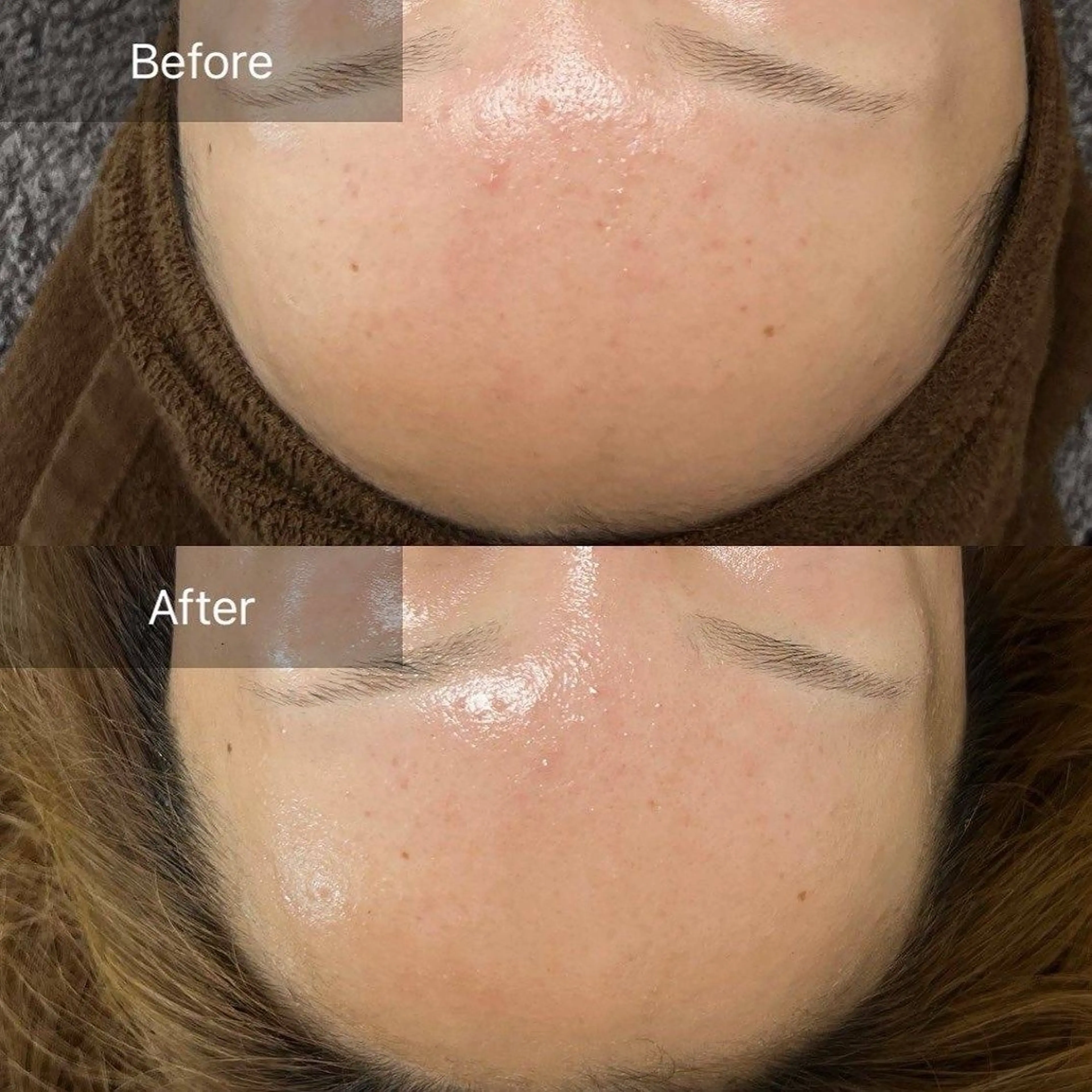 ハーブピーリング/韓国肌管理/フェイシャル/毛穴洗浄/眉毛/顔脱毛【糸脱毛専門】rev所属・ハーブピーリング専門 毛穴洗浄❤️眉waxのエステ・リラクイメージ