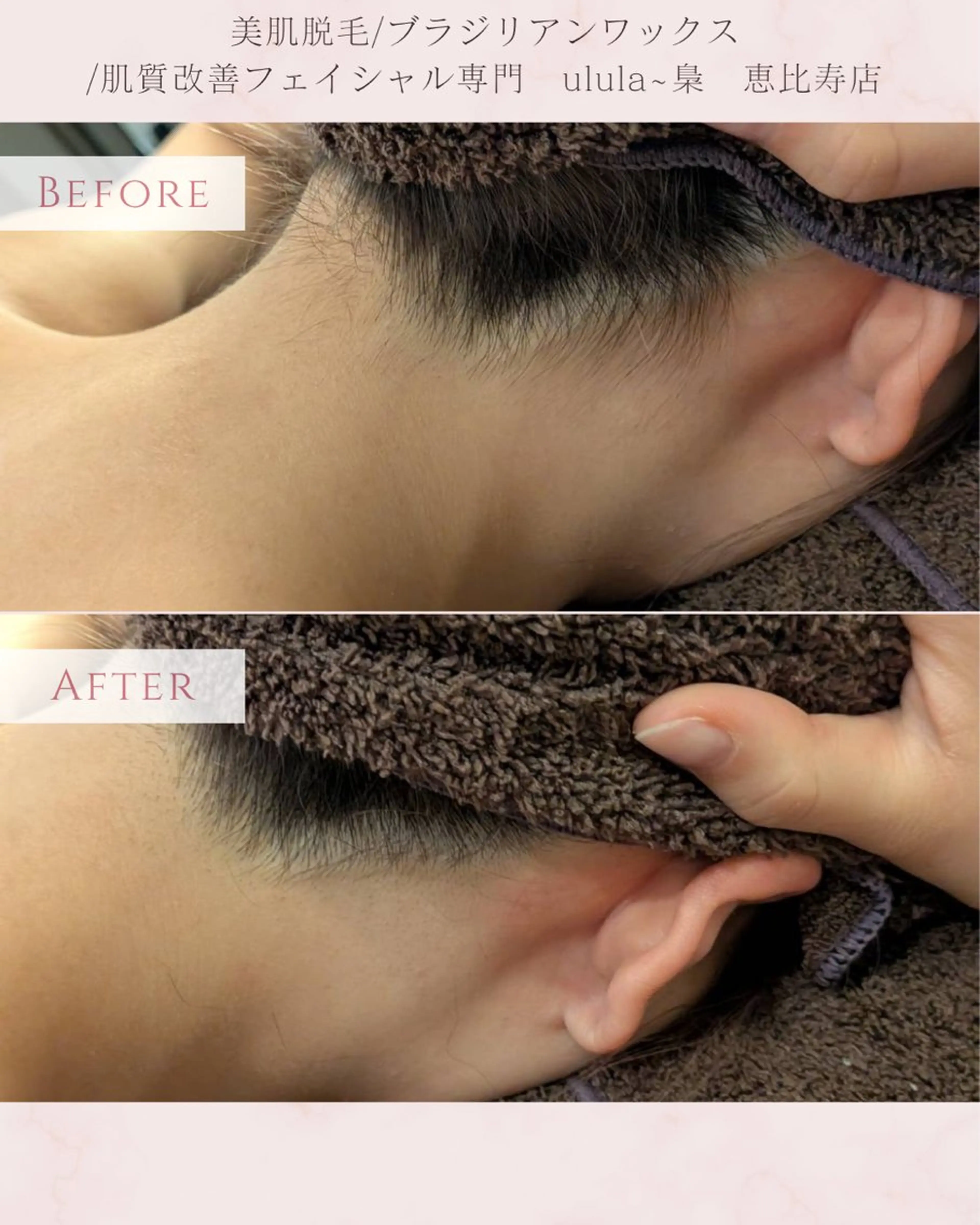 脱毛 美肌脱毛/肌質改善 《ulula～梟》のエステ・リラクイメージ