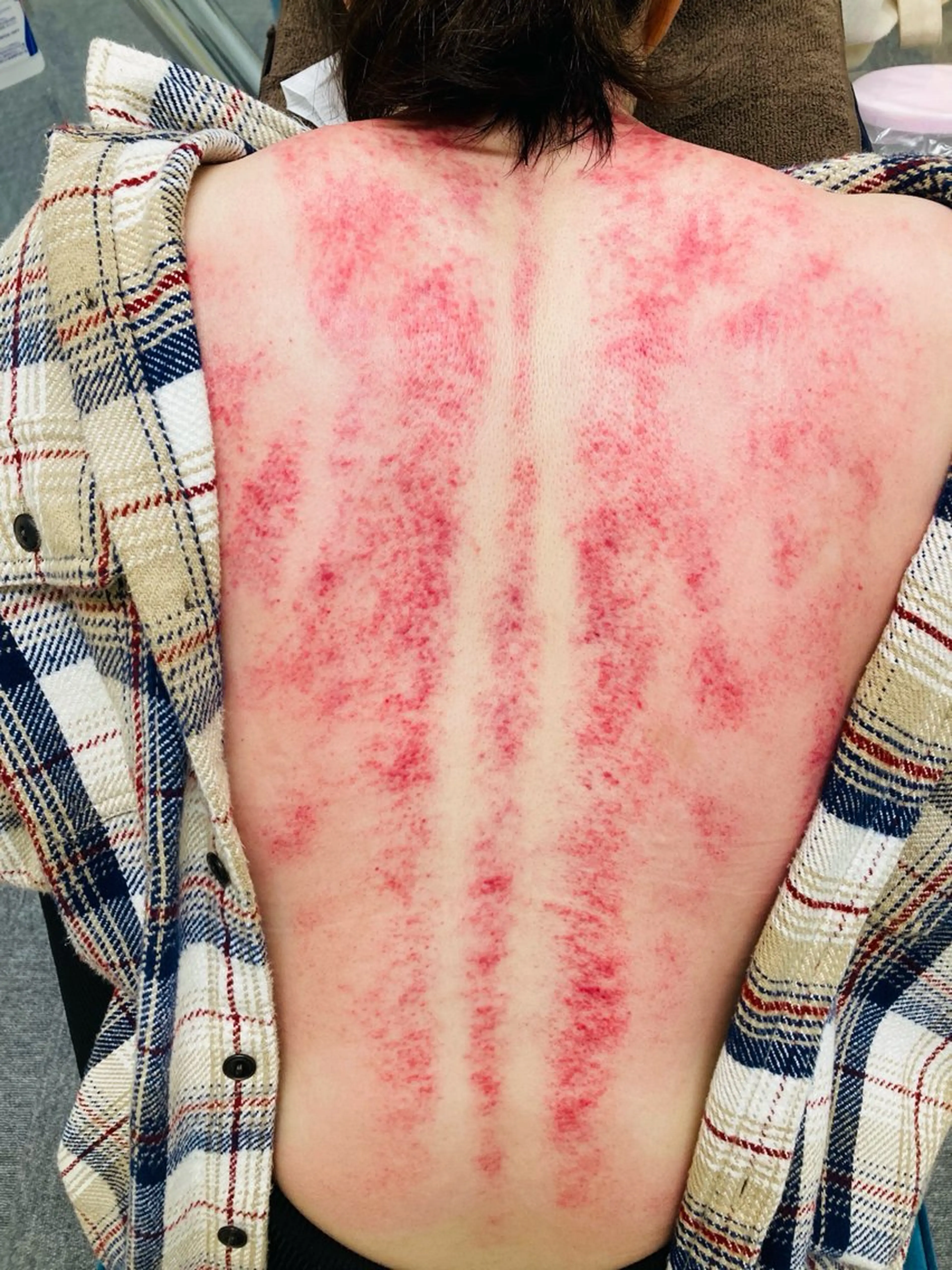 台湾式カッサ（首/肩/背中/腰）の写真