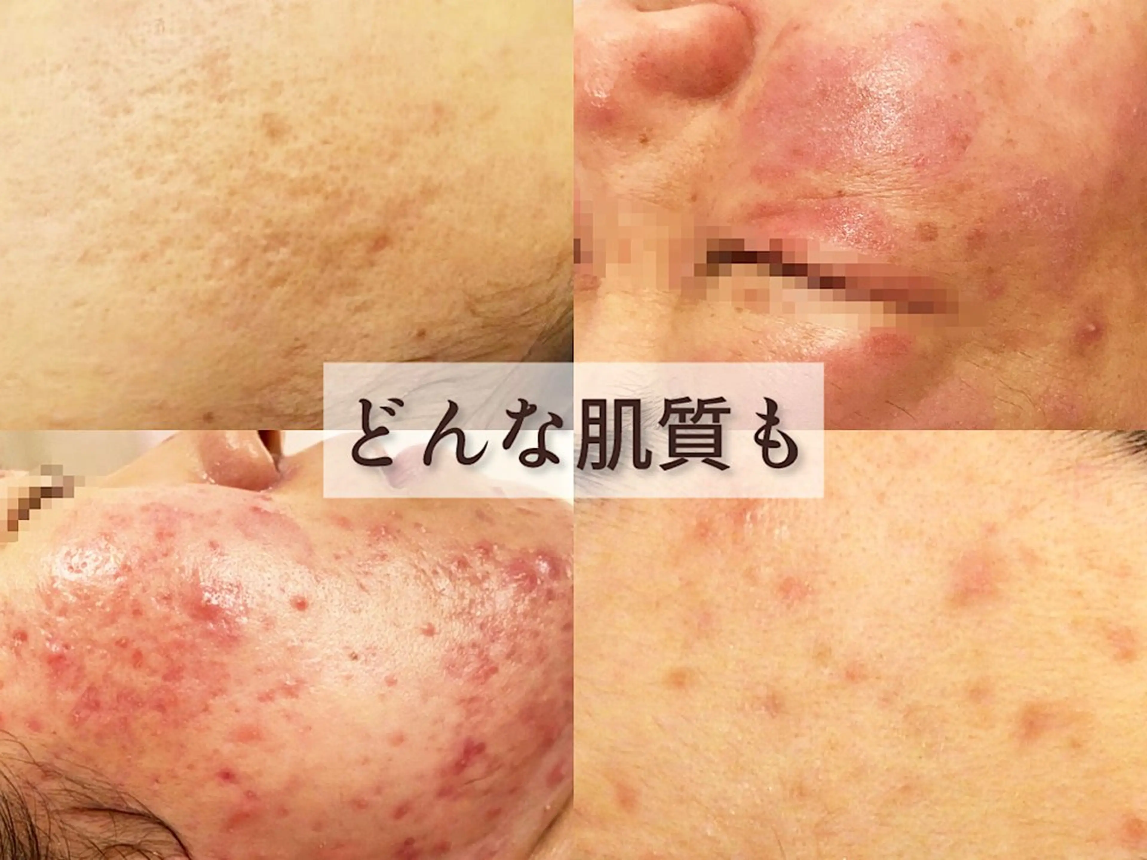 エステ リラク 繰り返すニキビ・毛穴 ✨つくば肌質改善専門のエステ・リラクイメージ