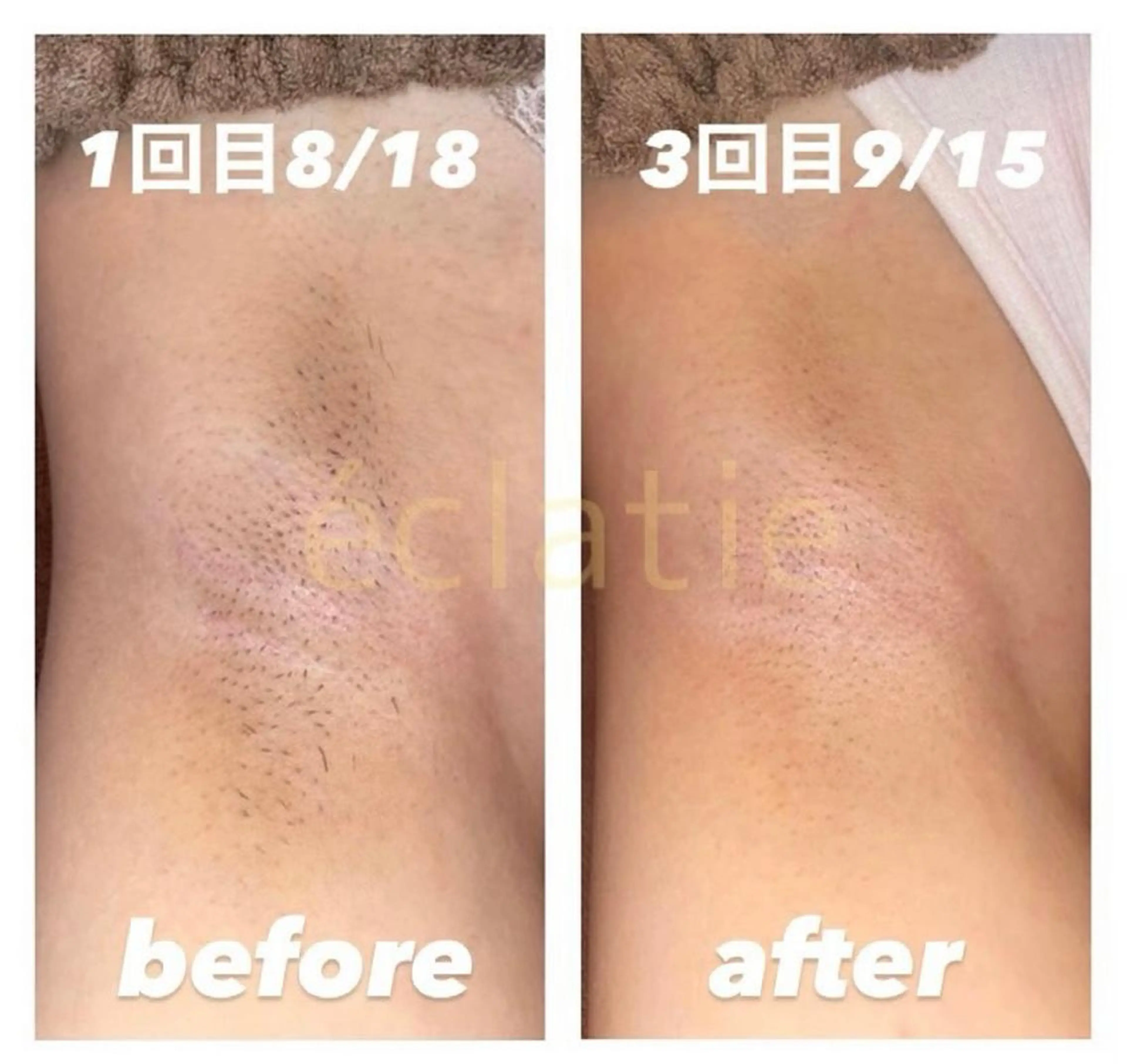 脱毛 eclatie(エクラティエ)所属・横井 愛奈のエステ・リラクイメージ