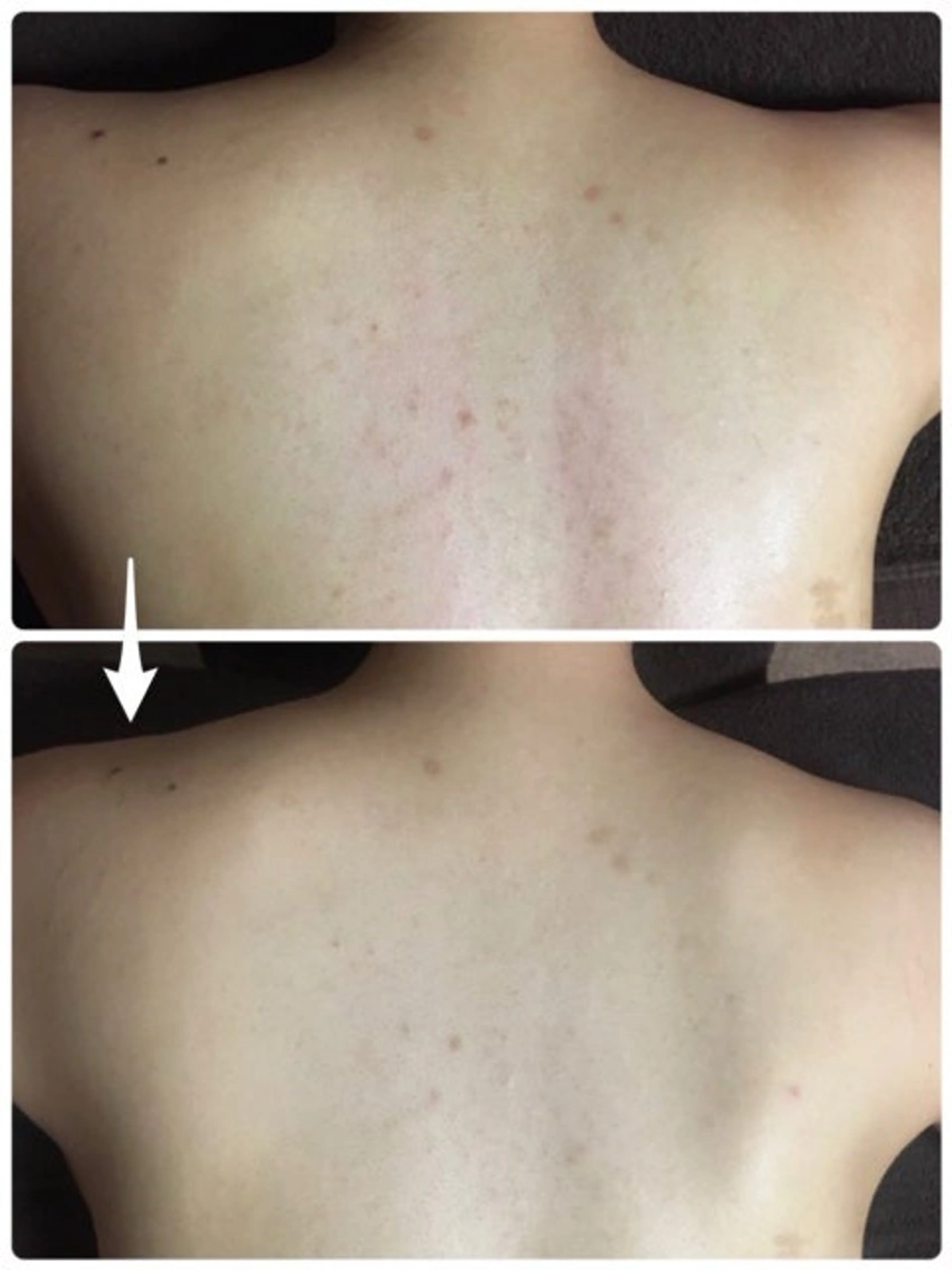 エステ ハーブピーリング/韓国肌管理/フェイシャル/毛穴洗浄/眉毛/顔脱毛【糸脱毛専門】rev所属・ハーブピーリング専門 毛穴洗浄❤️眉waxのエステ・リラクイメージ