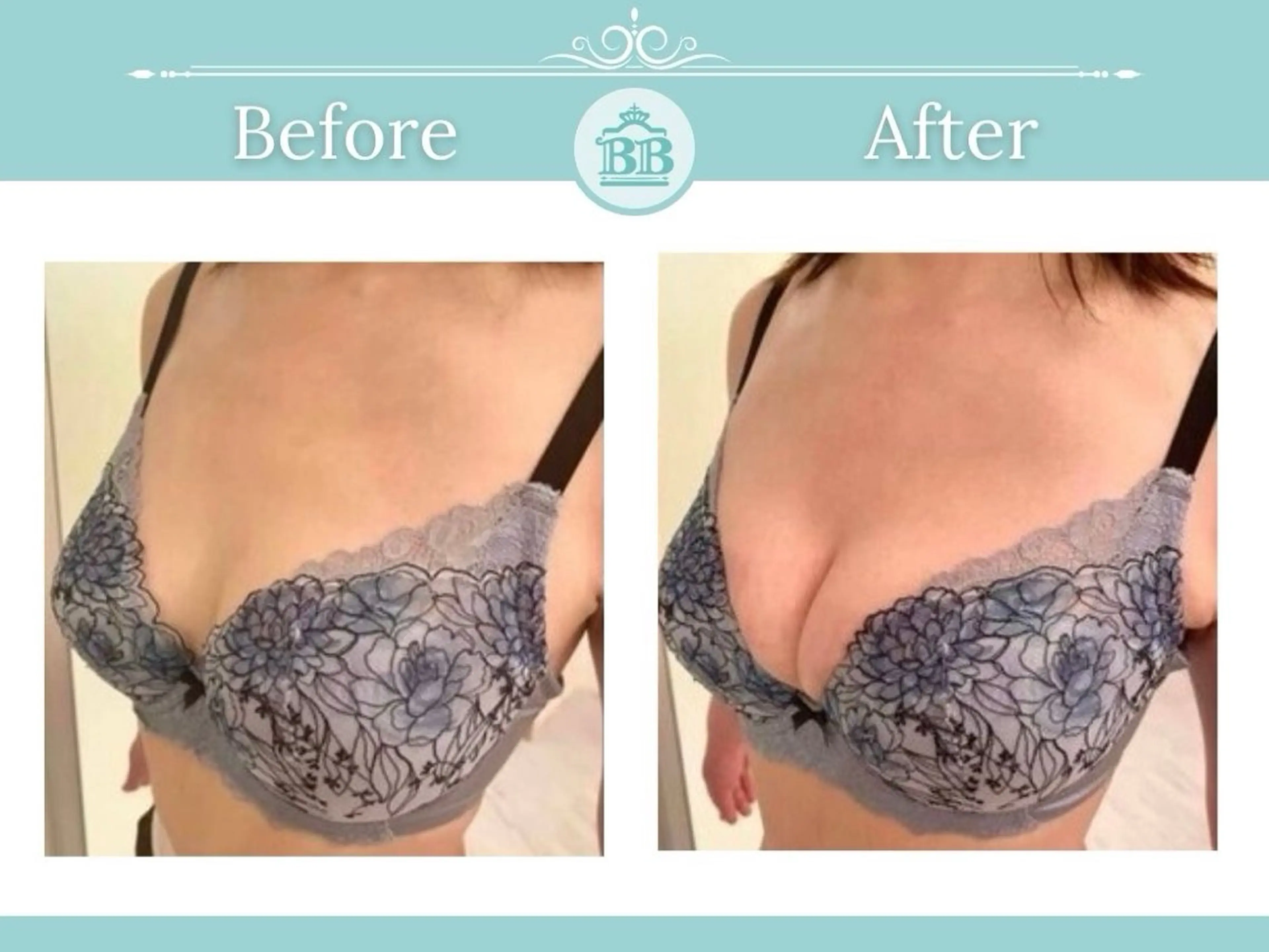 【バストアップ】バスト全身ケア(機械付)⚫︎60分※すぐ予約のみ【OPEN記念|無料モニター】の写真