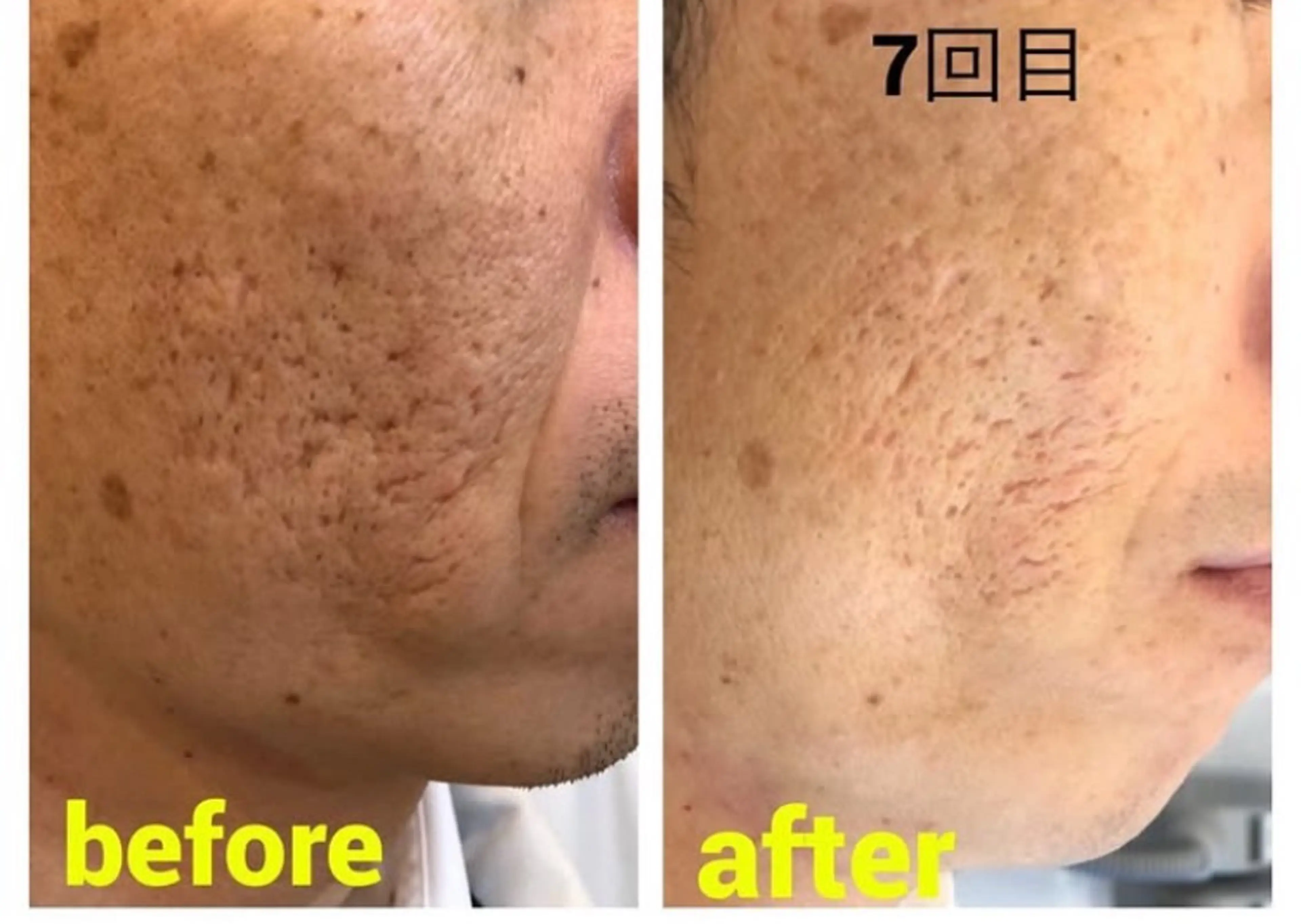 永久脱毛の写真