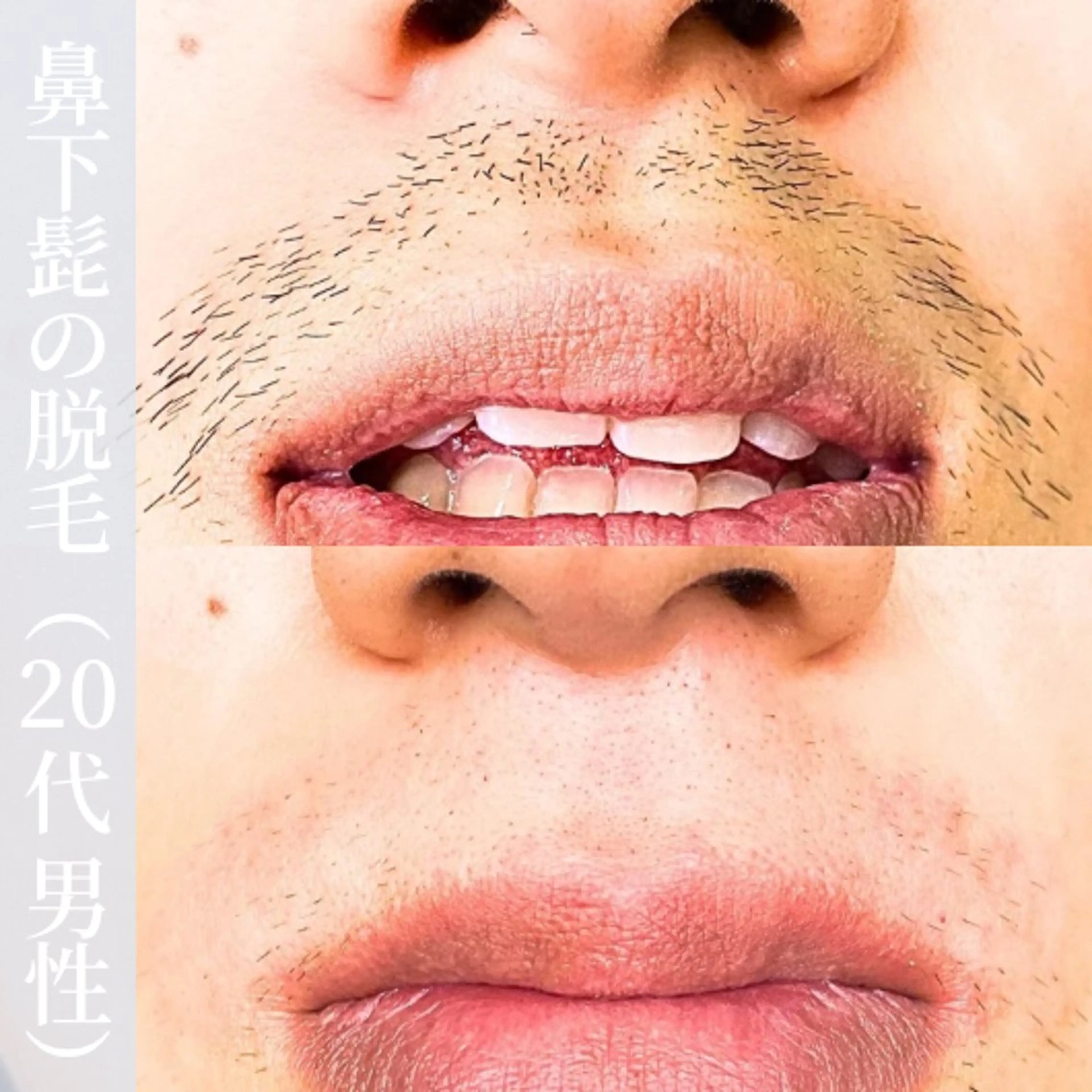 メンズ 【一本ずつ脱毛】 ReMove 柏のエステ・リラクイメージ