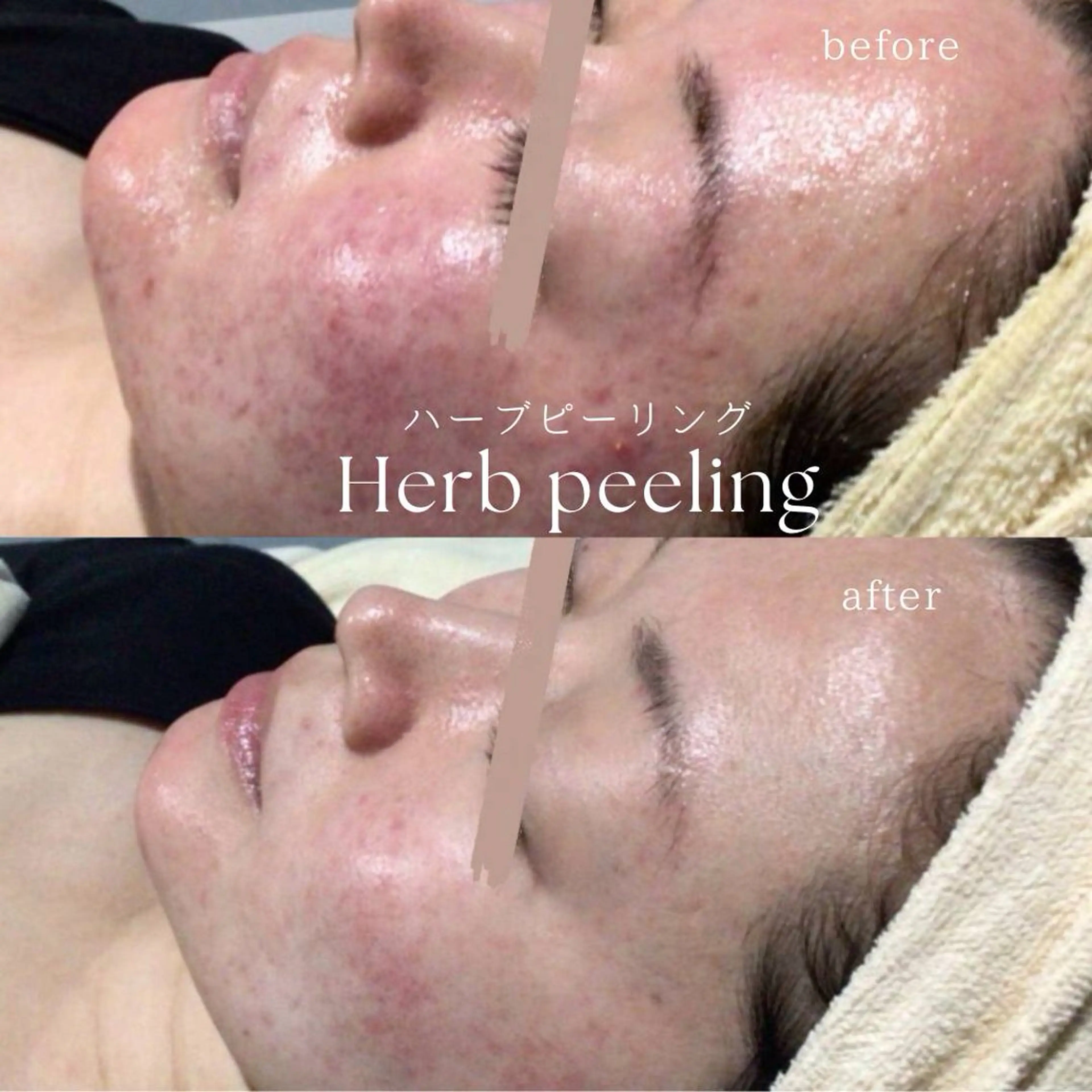 【ミニモ限定】 国産ハーブピーリング🌿/ダウンタイムなし/剥離なし/当日メイクOK/話題の次世代ハーブピーリングの写真