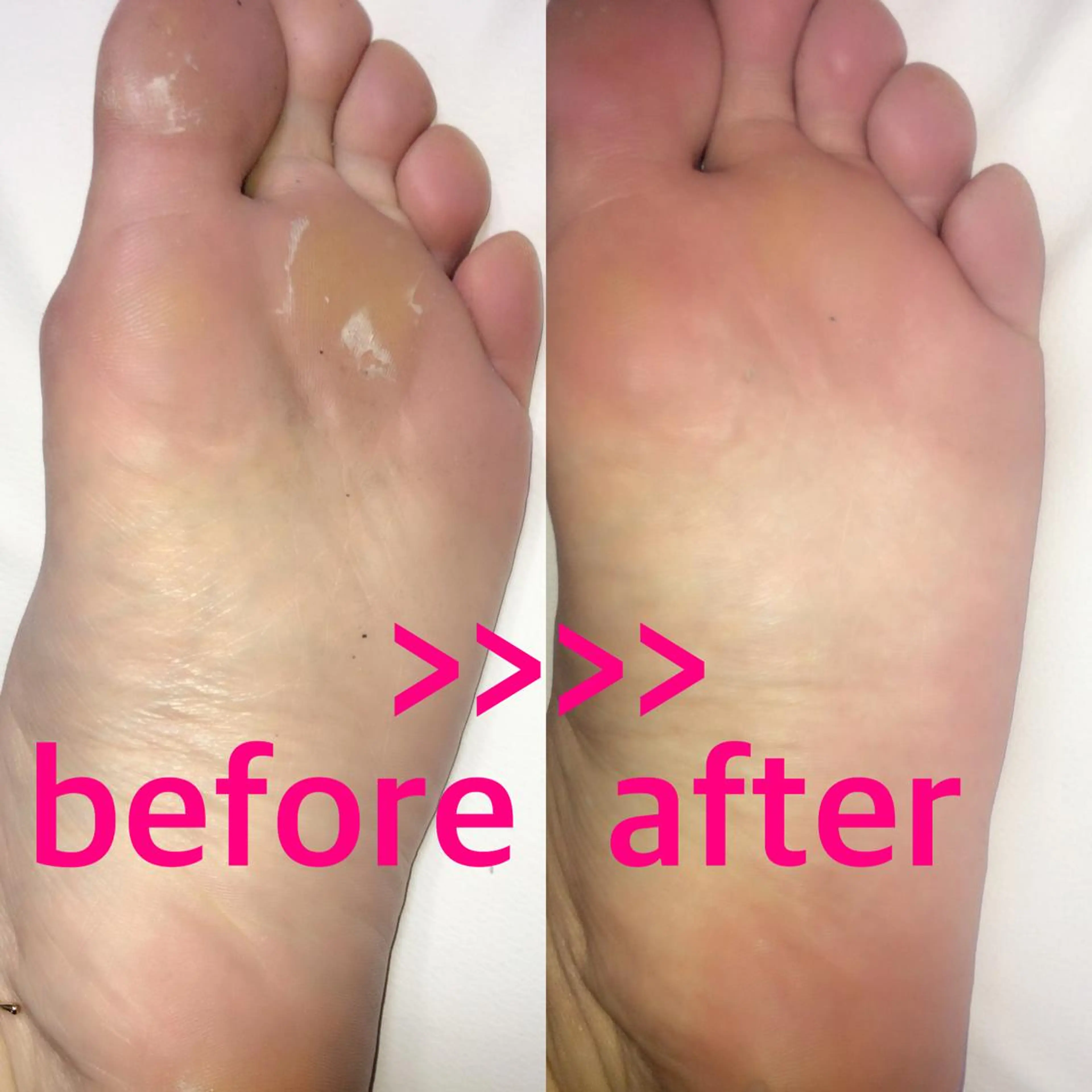 フット角質ケアの写真