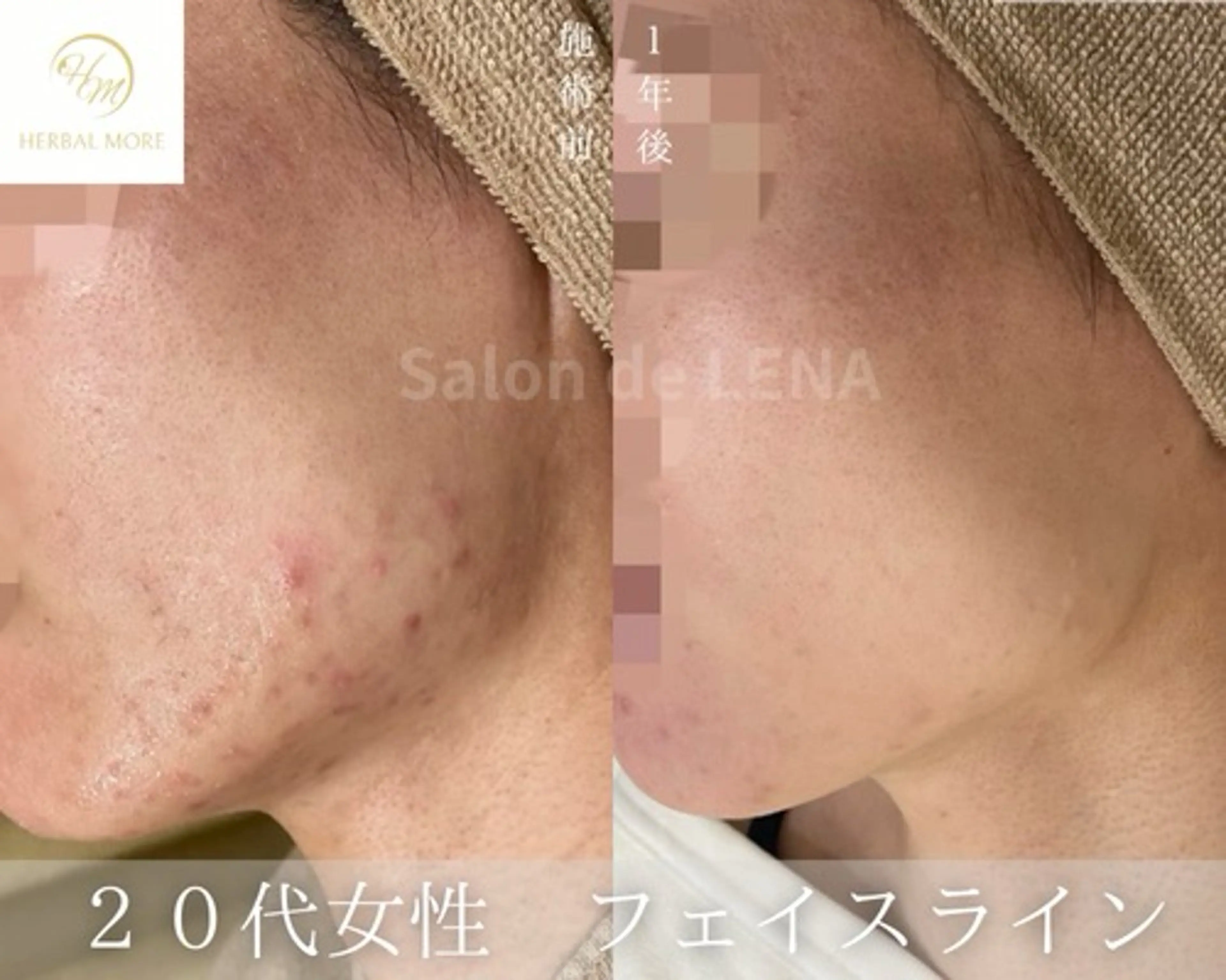 ハーブピーリング・毛穴ケア専門サロンSalon de LENA 栄店所属・ハーブピーリング専門 サロンドレナ　白藤のエステ・リラクイメージ