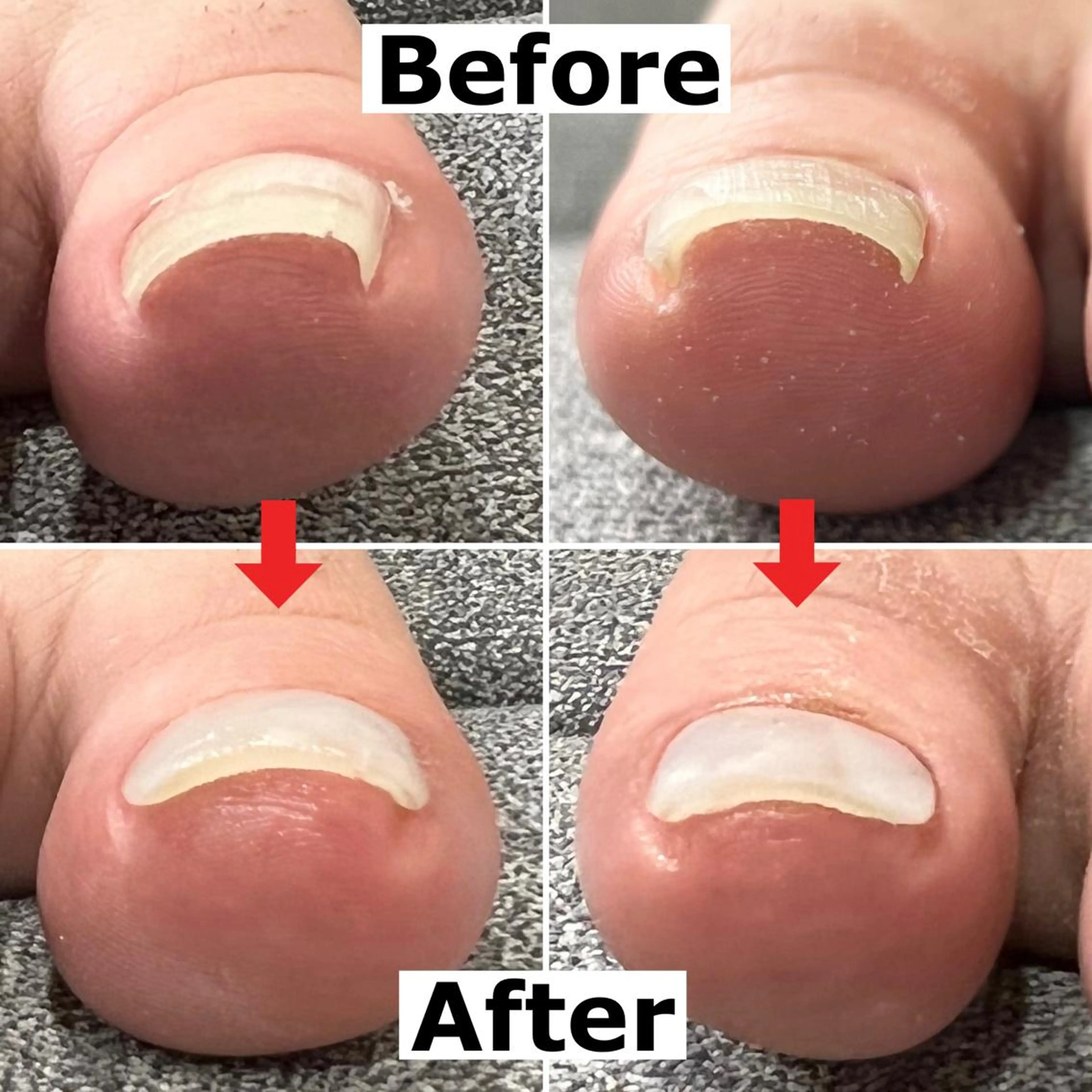 ネイル 巻爪無料モデル募集 ✨🦶MEGUMIのネイルデザイン