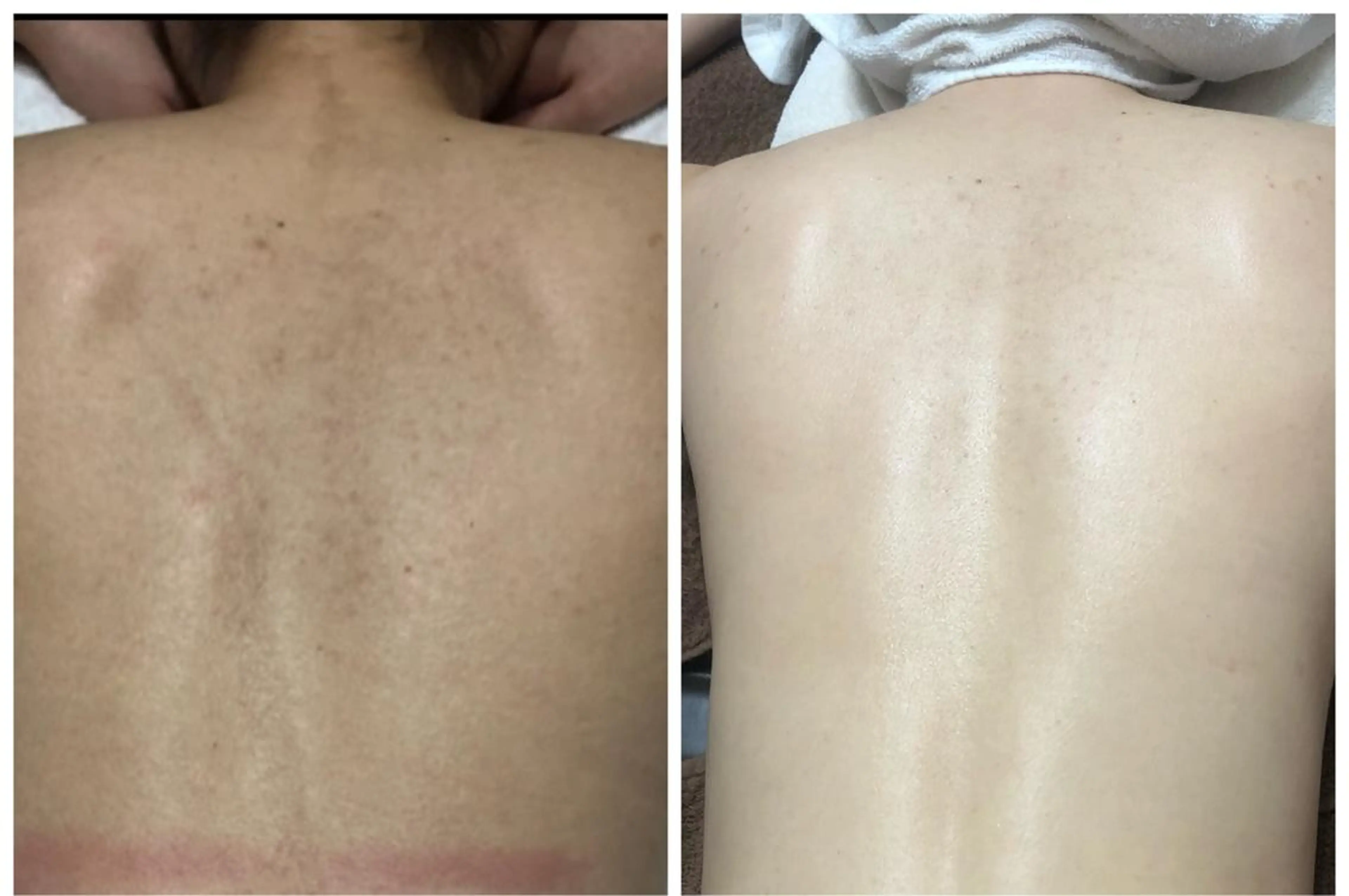 レディース全身脱毛すごくお得!!の写真