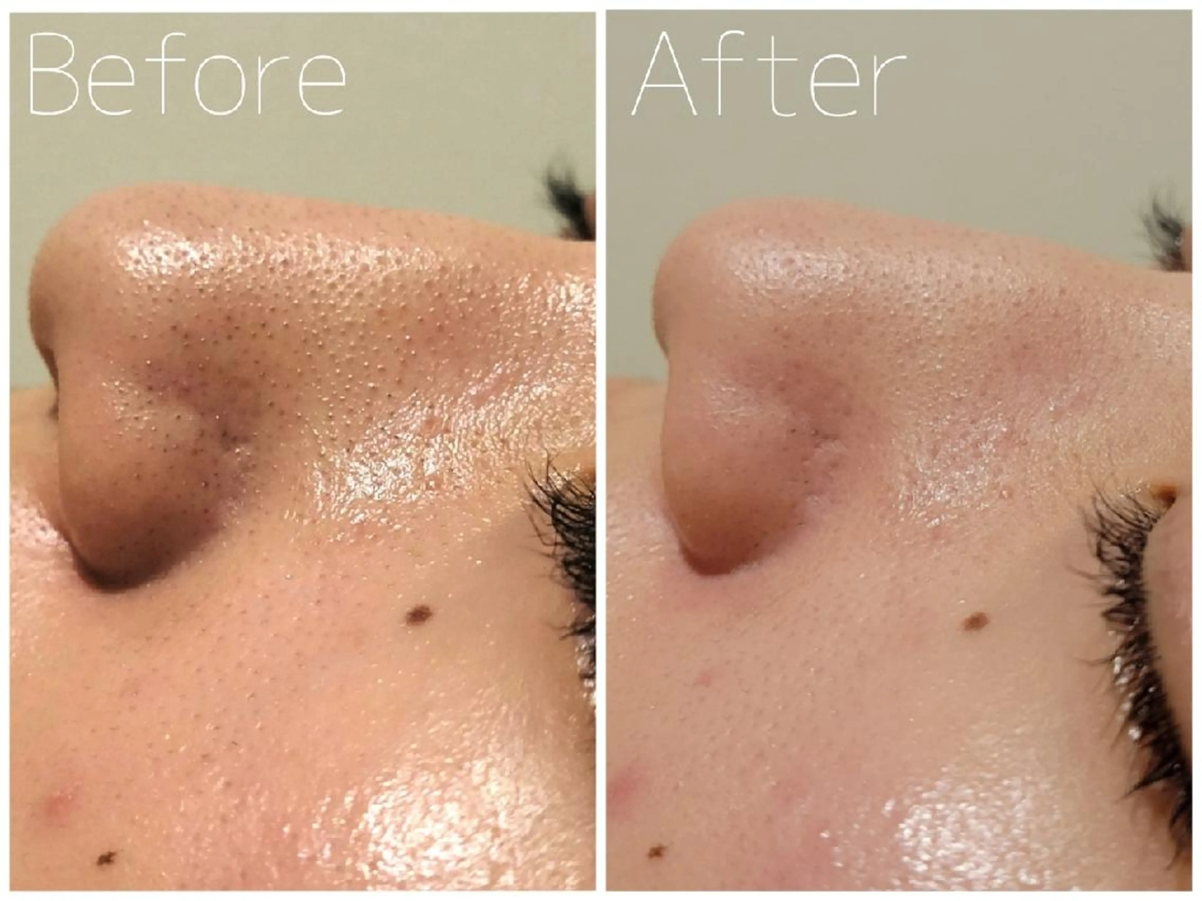 3月限定【毛穴の角栓・黒ずみケア‎】毛穴洗浄/ピーリング/肌管理 16500円➡の写真