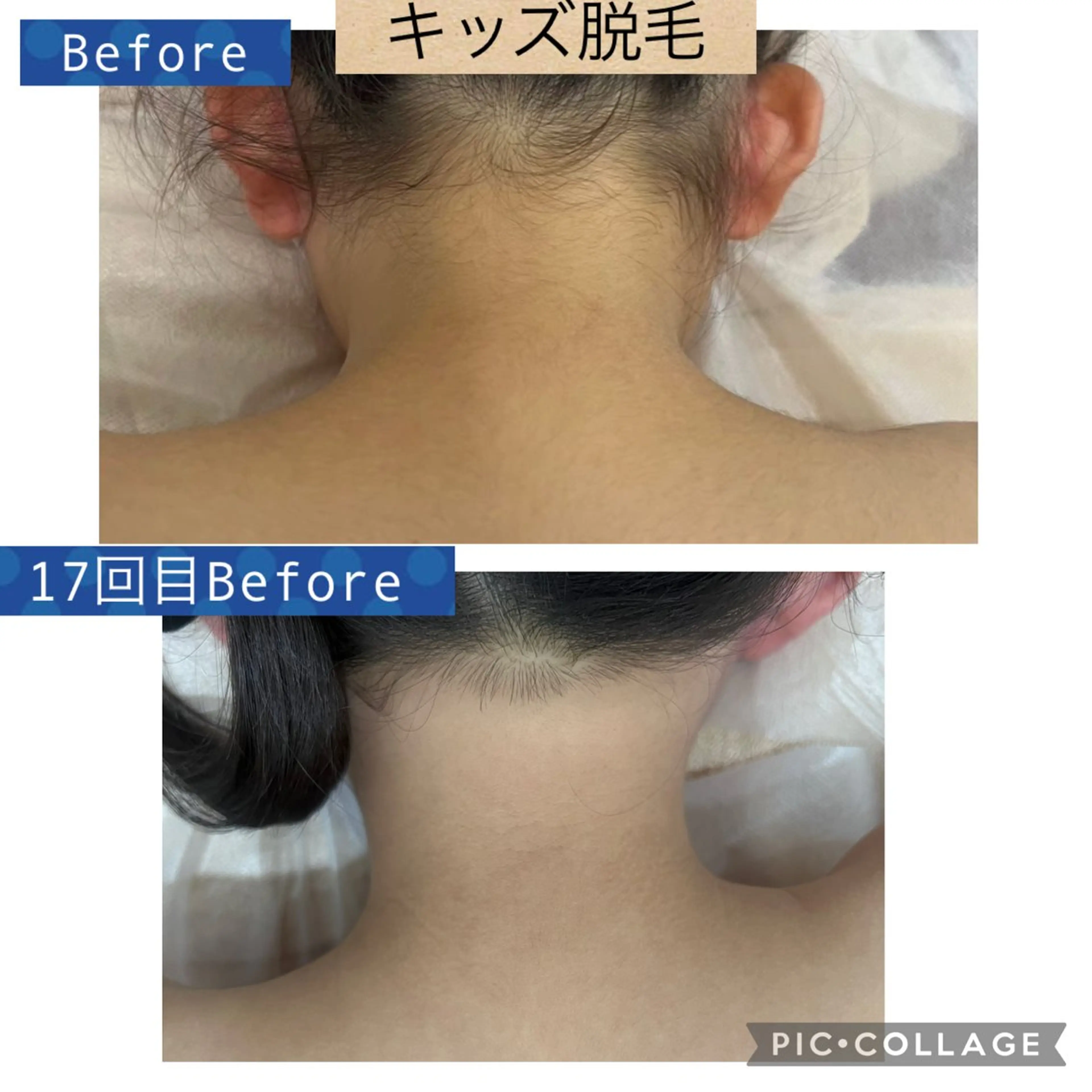 脱毛 ブライダル痩身×脱毛 尼崎駅前サロンのエステ・リラクイメージ