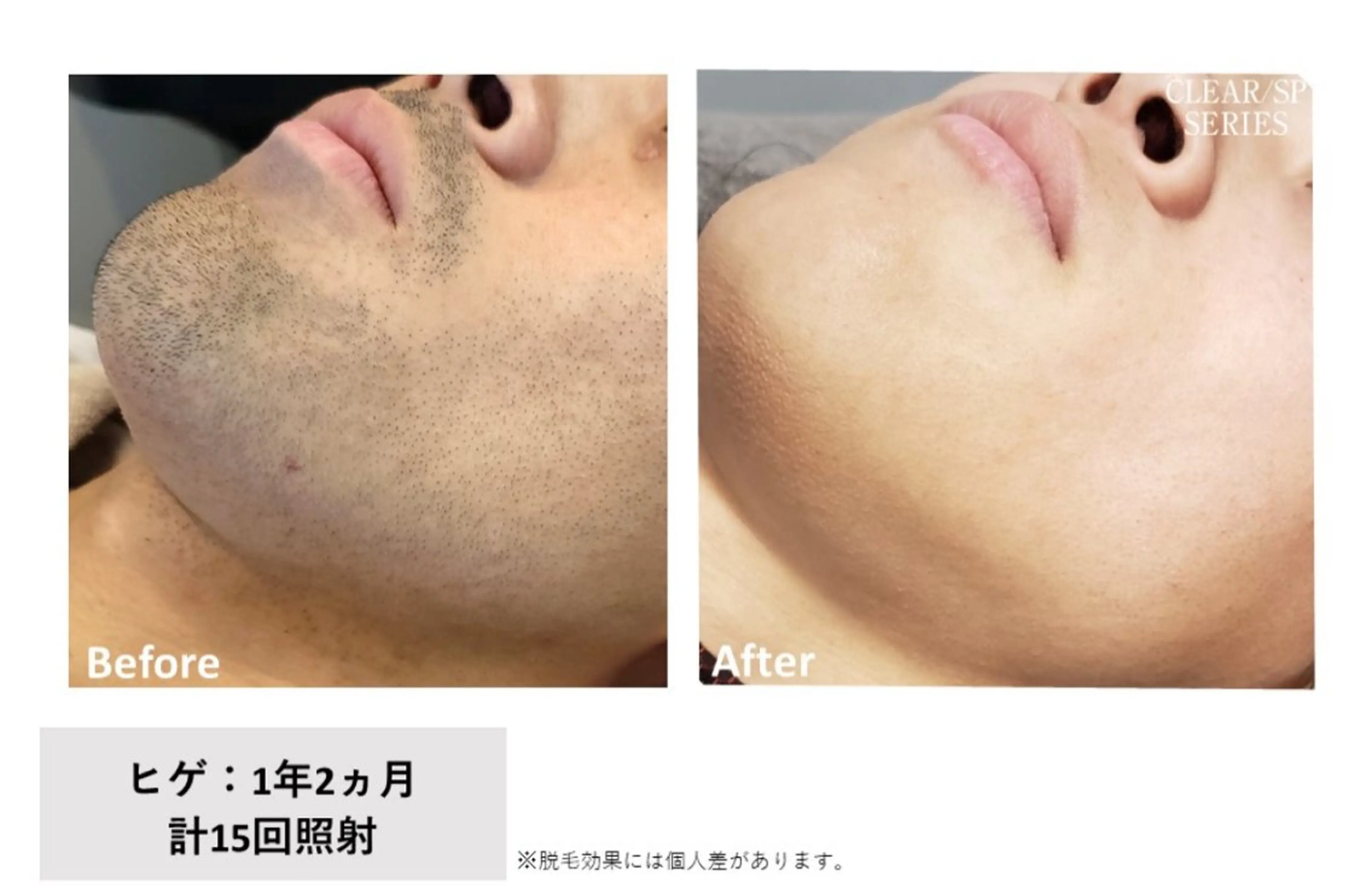 メンズヒゲ全体の写真