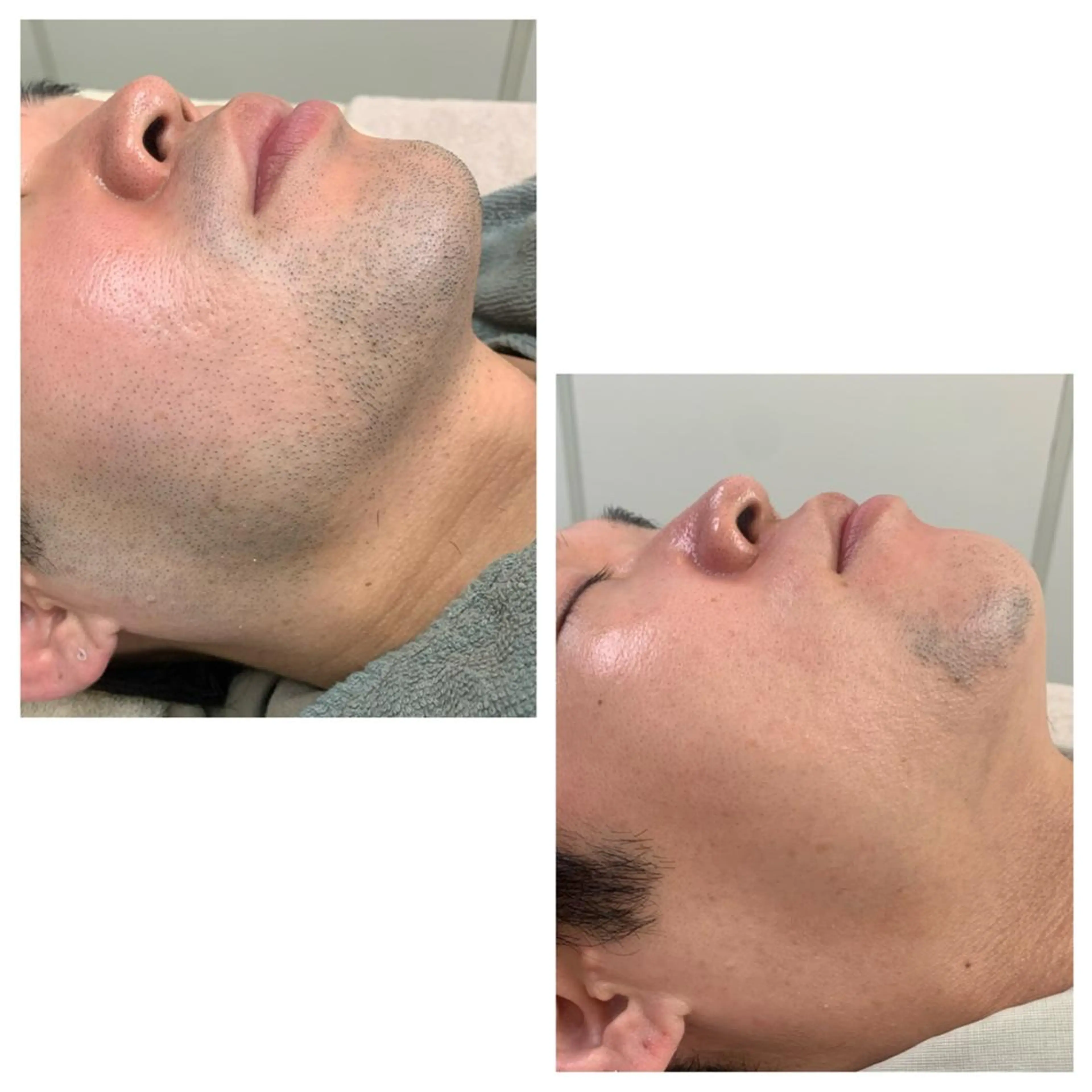 顔脱毛(髭脱毛)の写真