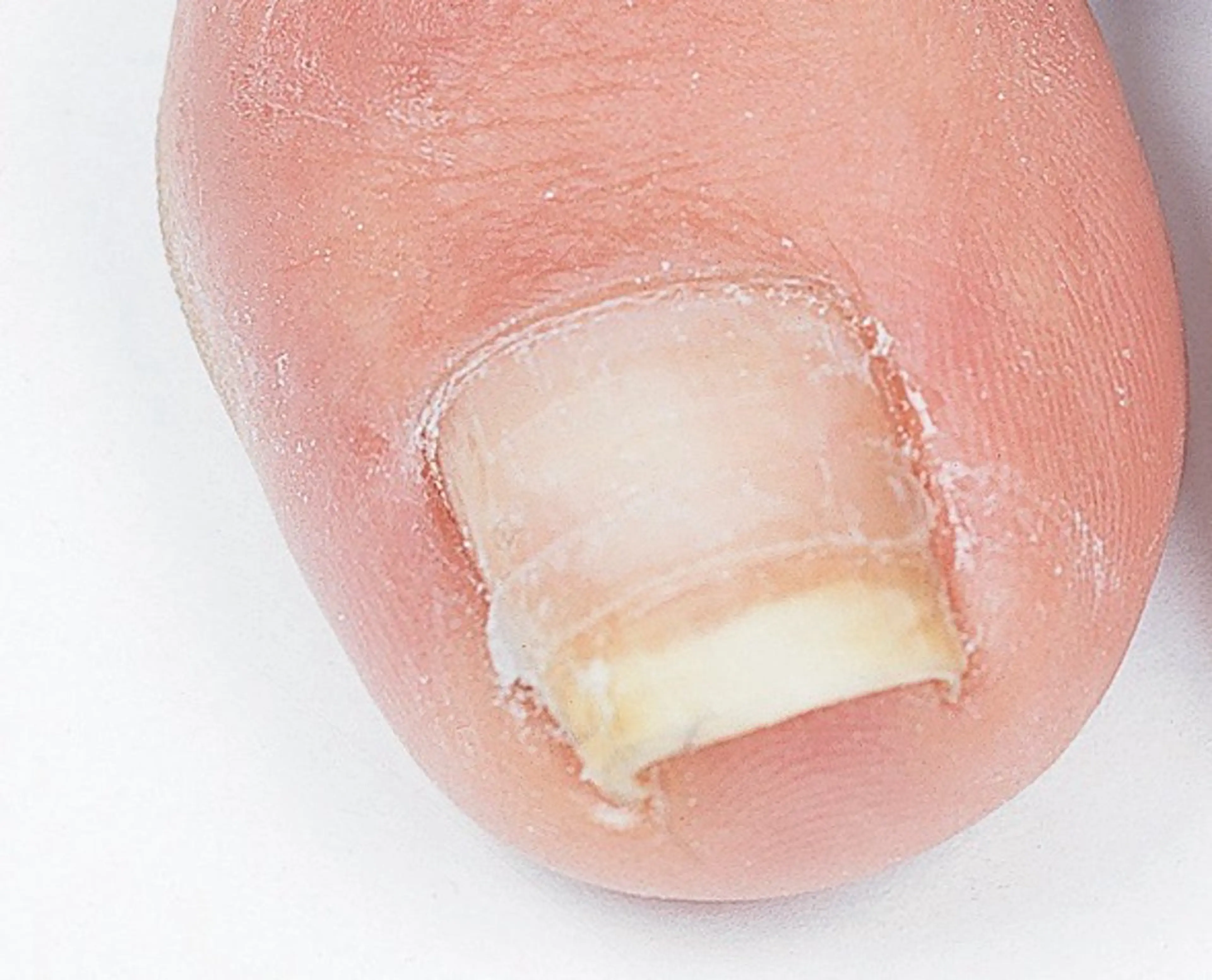 🌟ご新規様限定🌟【巻き爪】B/Sブレイス 両親指(初回他店オフ無料) 甘皮ケア付き✨の写真