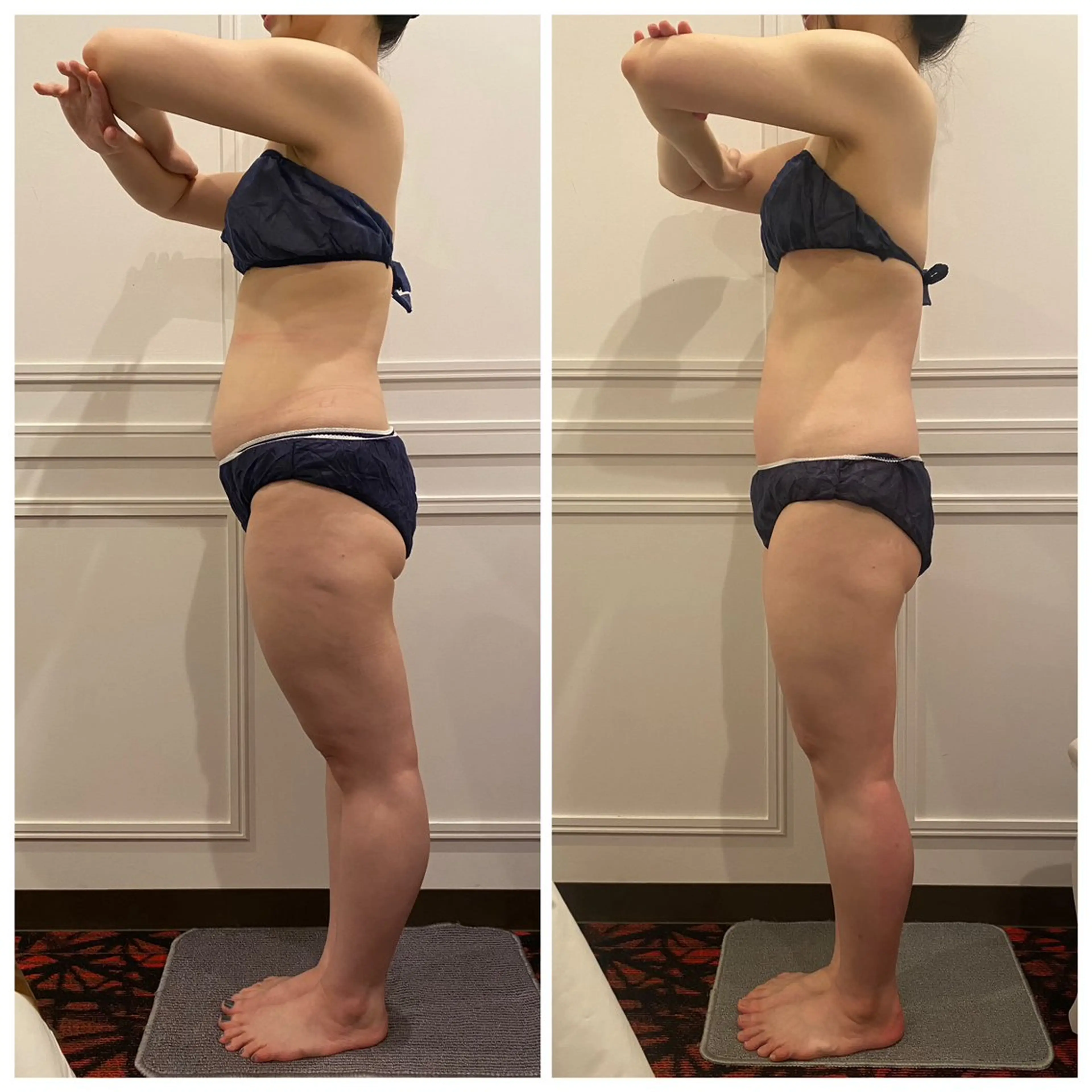 💫実は1番おすすめ⭐️ 全身速攻ケア🔥大満足❣️の体感❤️脂肪撃退×浮腫み流し！ハイパーナイフEX❤️‍🔥の写真