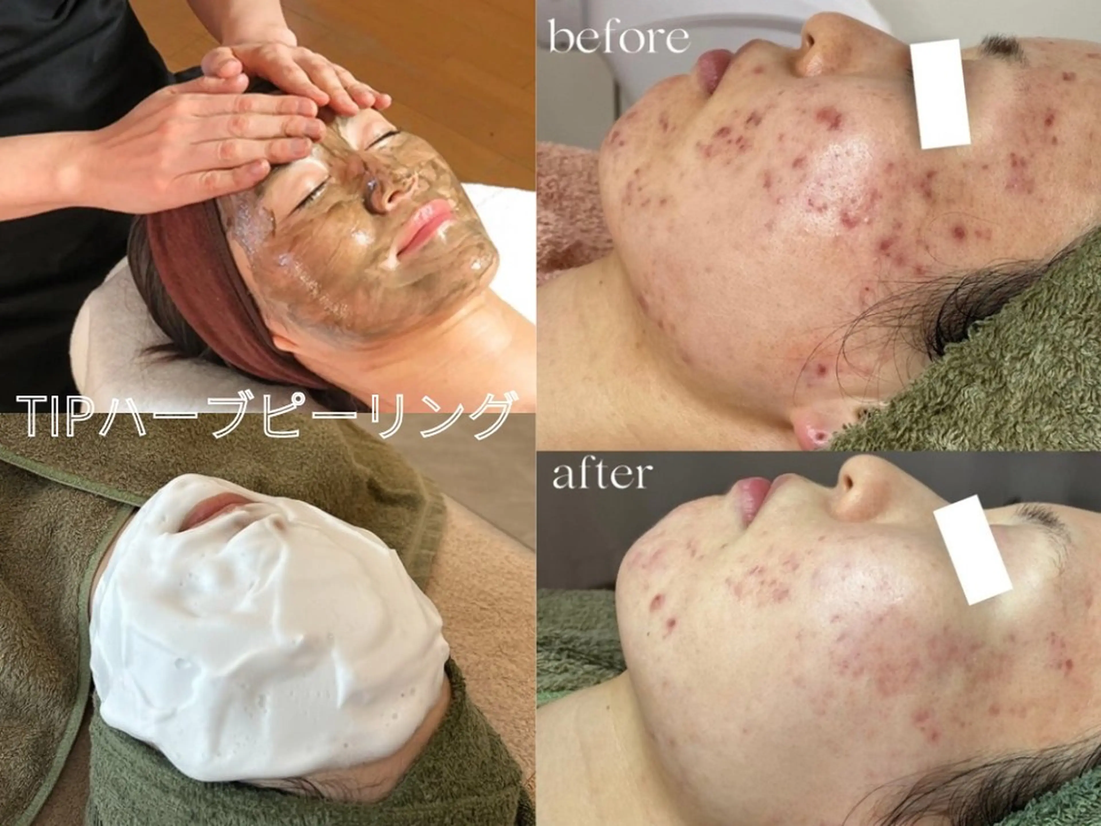 【3・4月限定】TIPハーブピーリング♪陶器肌￥14,000円→￥8,00円ミニモ限定の写真