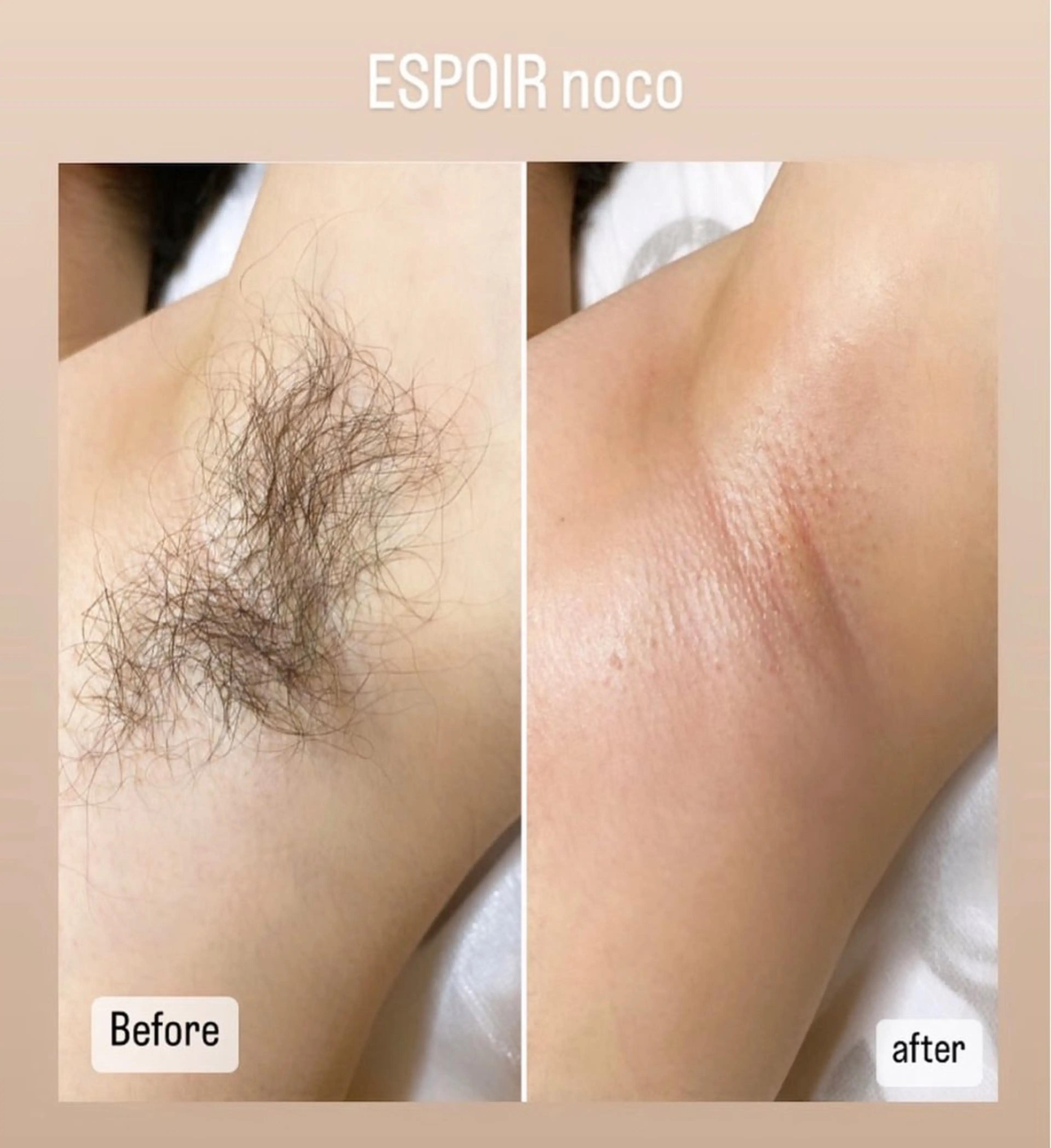 minimo限定✨メンズ脇Wax脱毛🌈【10時​〜​17時限定】の写真