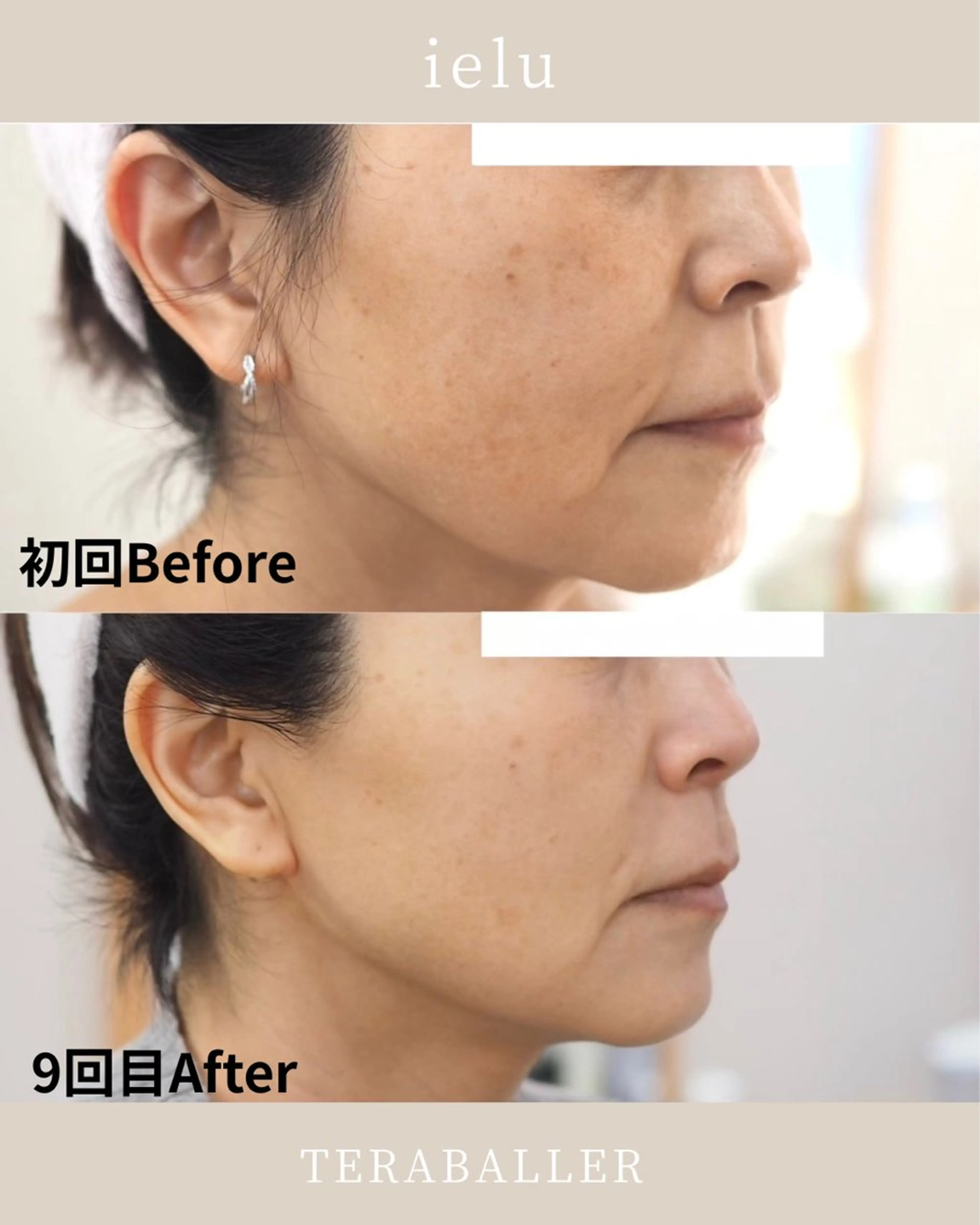 ielu〜毛穴ケア ハーブピーリングのエステ・リラクイメージ