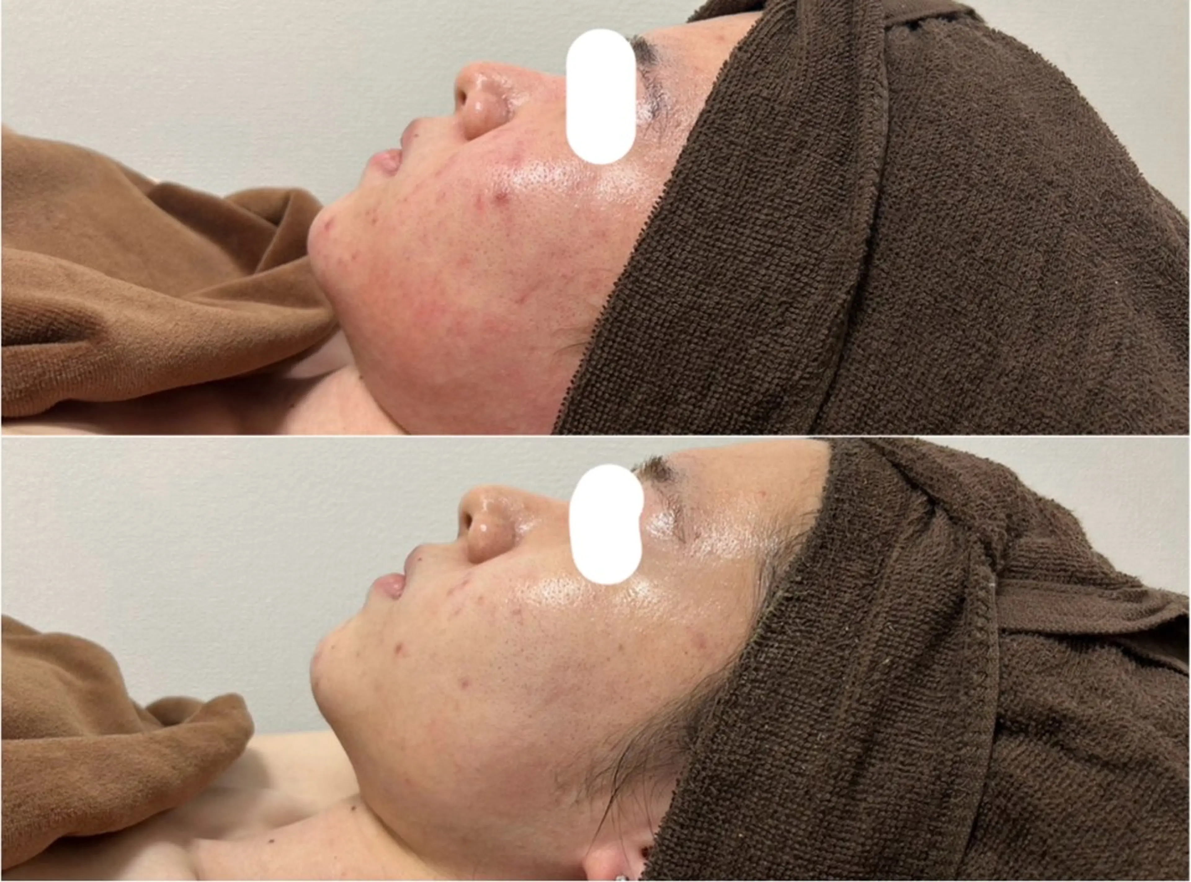 【オススメNo.1】くすみOFF！透き通るようなツヤ肌へ。高濃度炭酸パック¥5500の写真