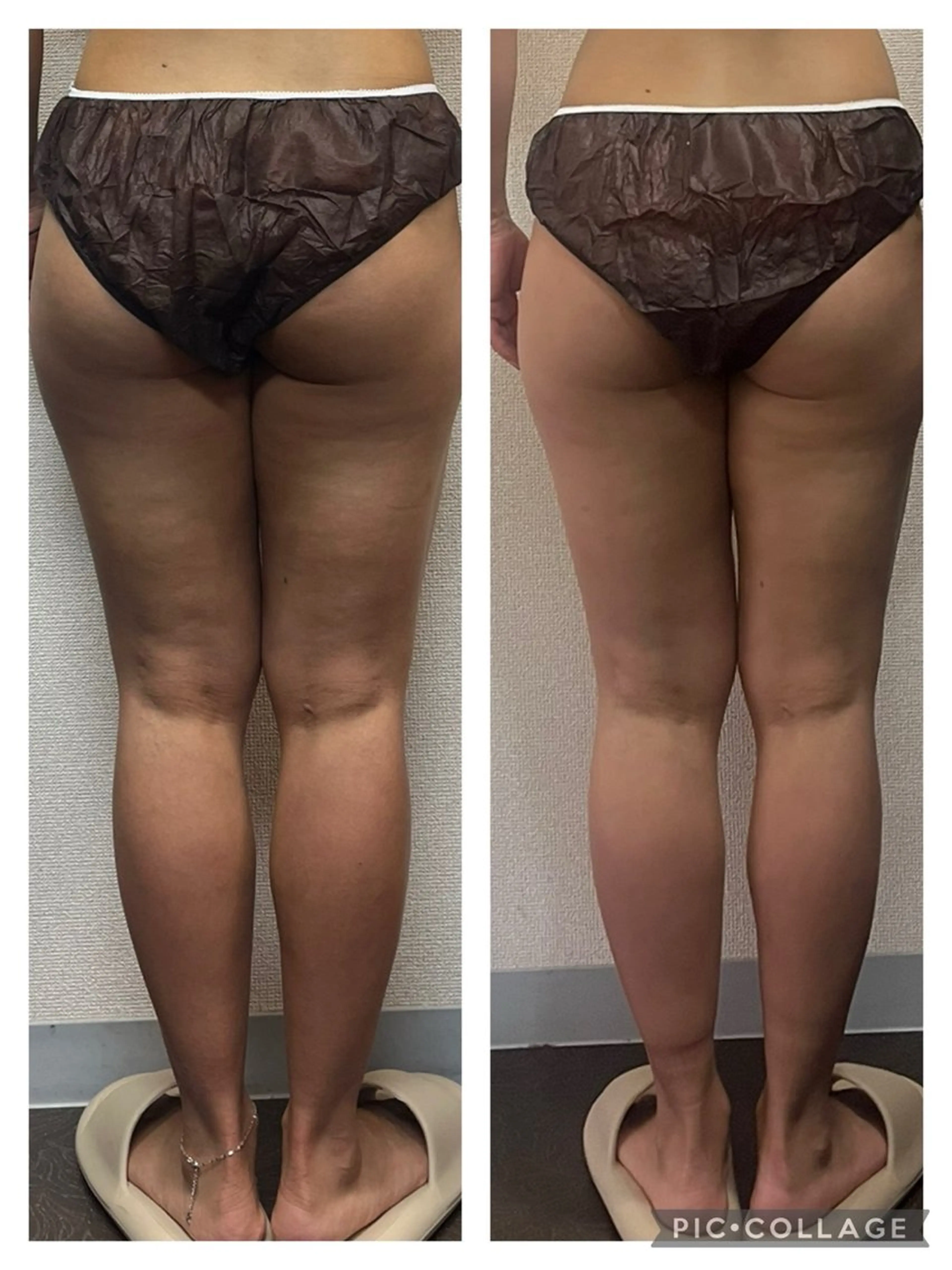 《即効美脚》下半身ハイパーナイフ×強圧リンパマッサージの写真