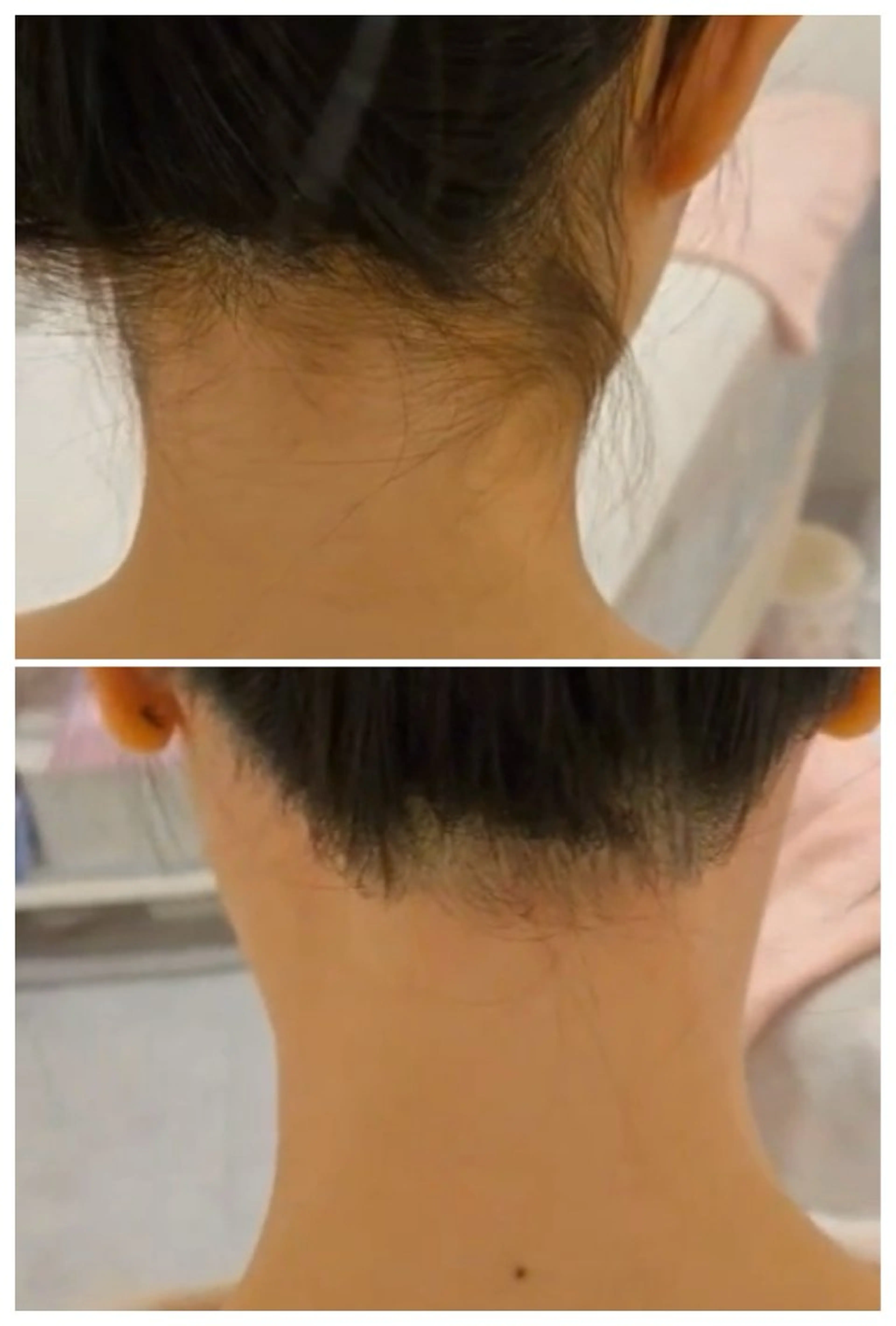 韓国脱毛シュガーリングうなじの写真